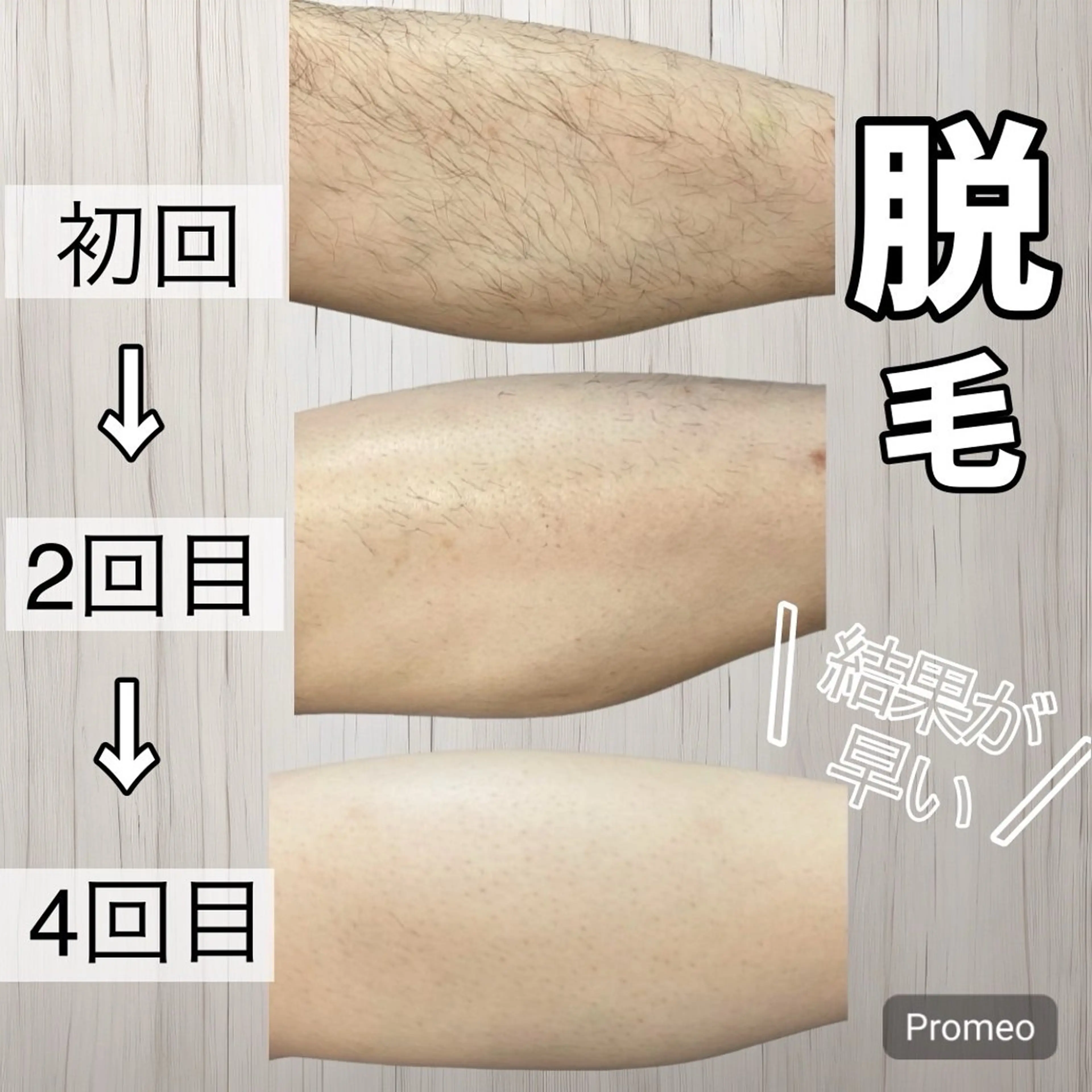 エステラボ　ei-B  王寺店所属・脱毛／脱毛 ／ボディメンテナンスのエステ・リラクイメージ