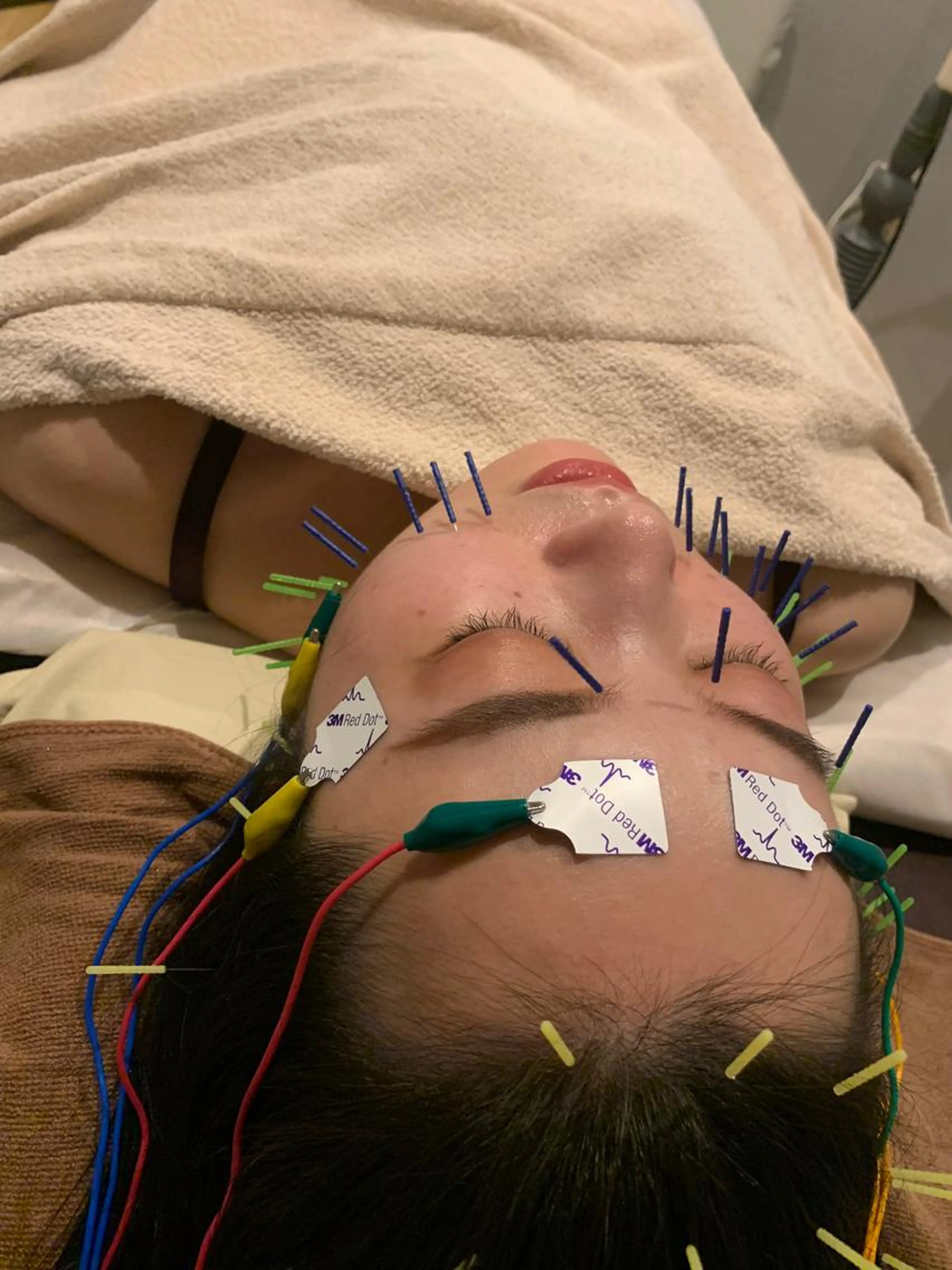 【🎄クリスマス限定価格🎅🎄❄️】スタンダード美容鍼✖️2回券の写真