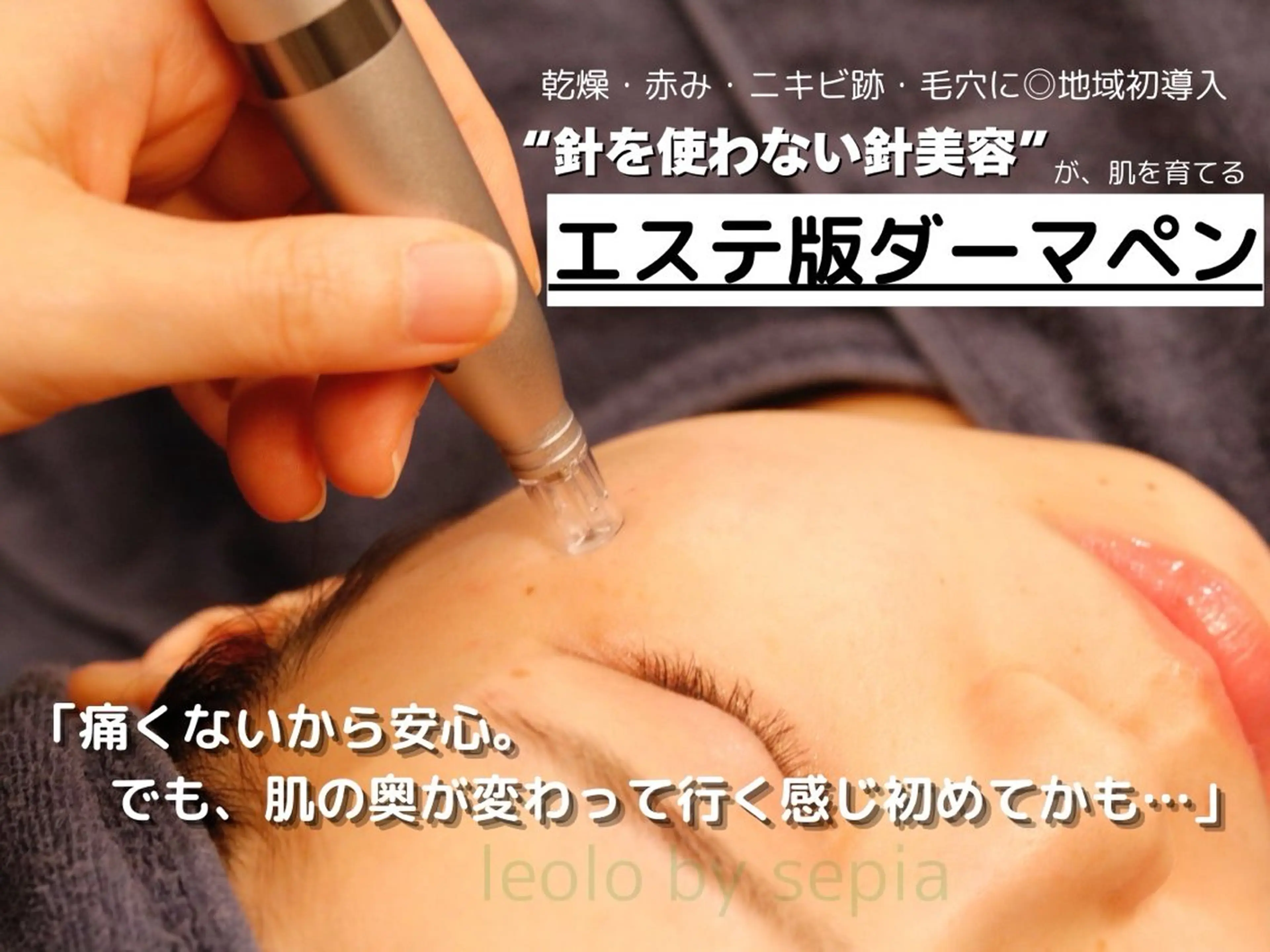 先着5名限定！【3回券モニター募集】最新ダーマペンで毛穴レス×ツヤ肌体験♡毛穴・凹凸悩みの方大歓迎✨ダウンタイムなし！の写真