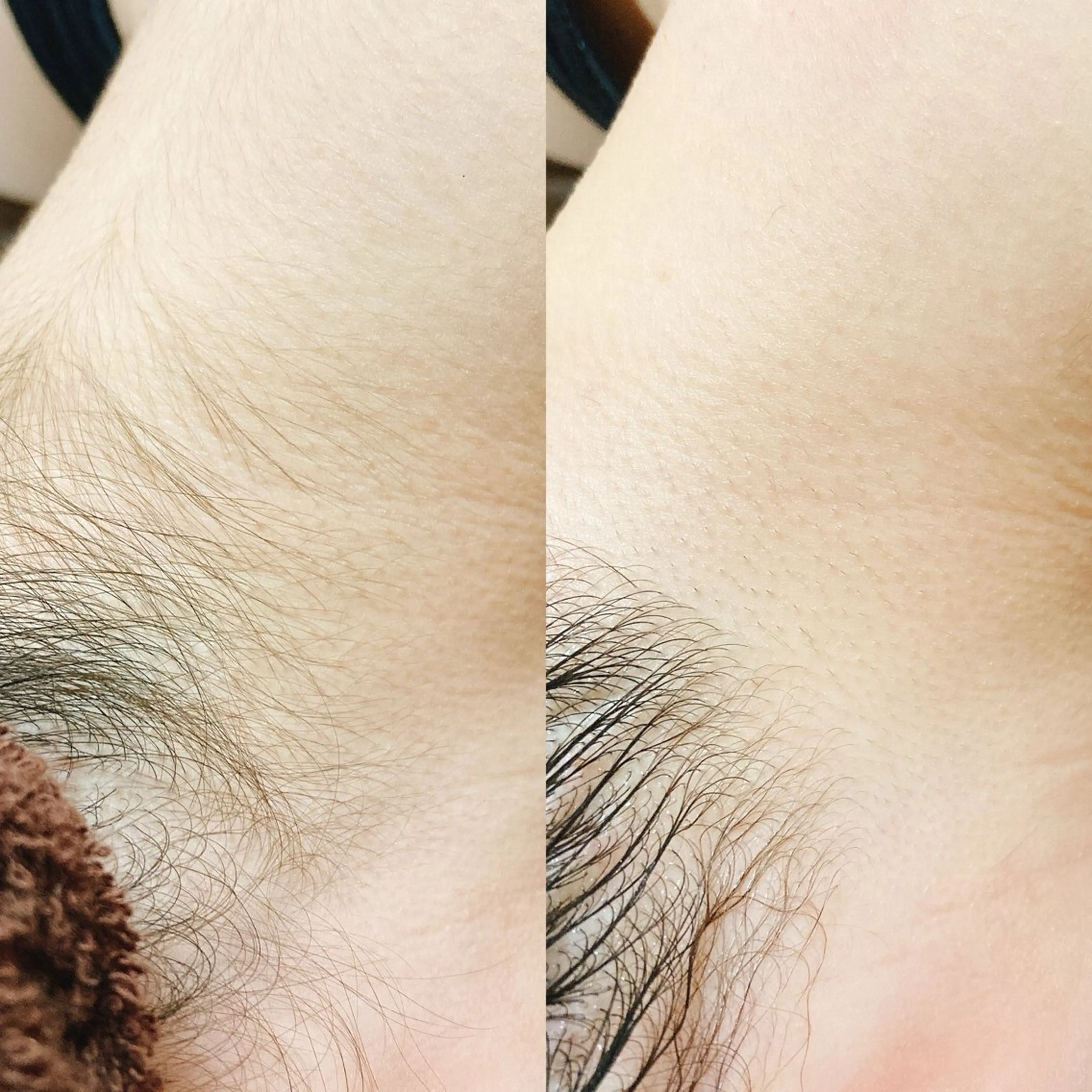 【LED美肌脱毛】顔脱毛（おでこ・頬・鼻下・口下・フェイスライン）パック付きの写真