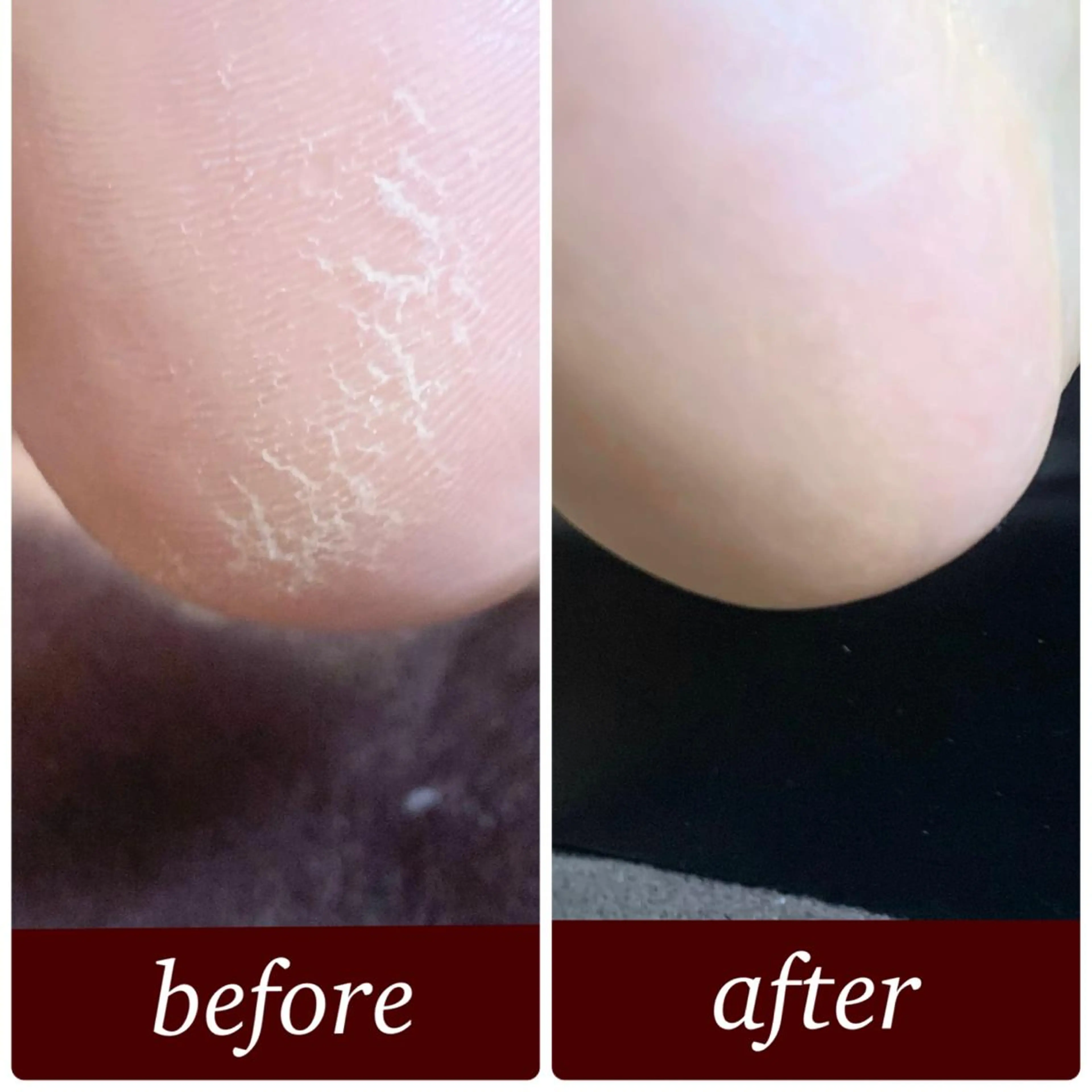 フットケア〔クイック角質ケア〕の写真