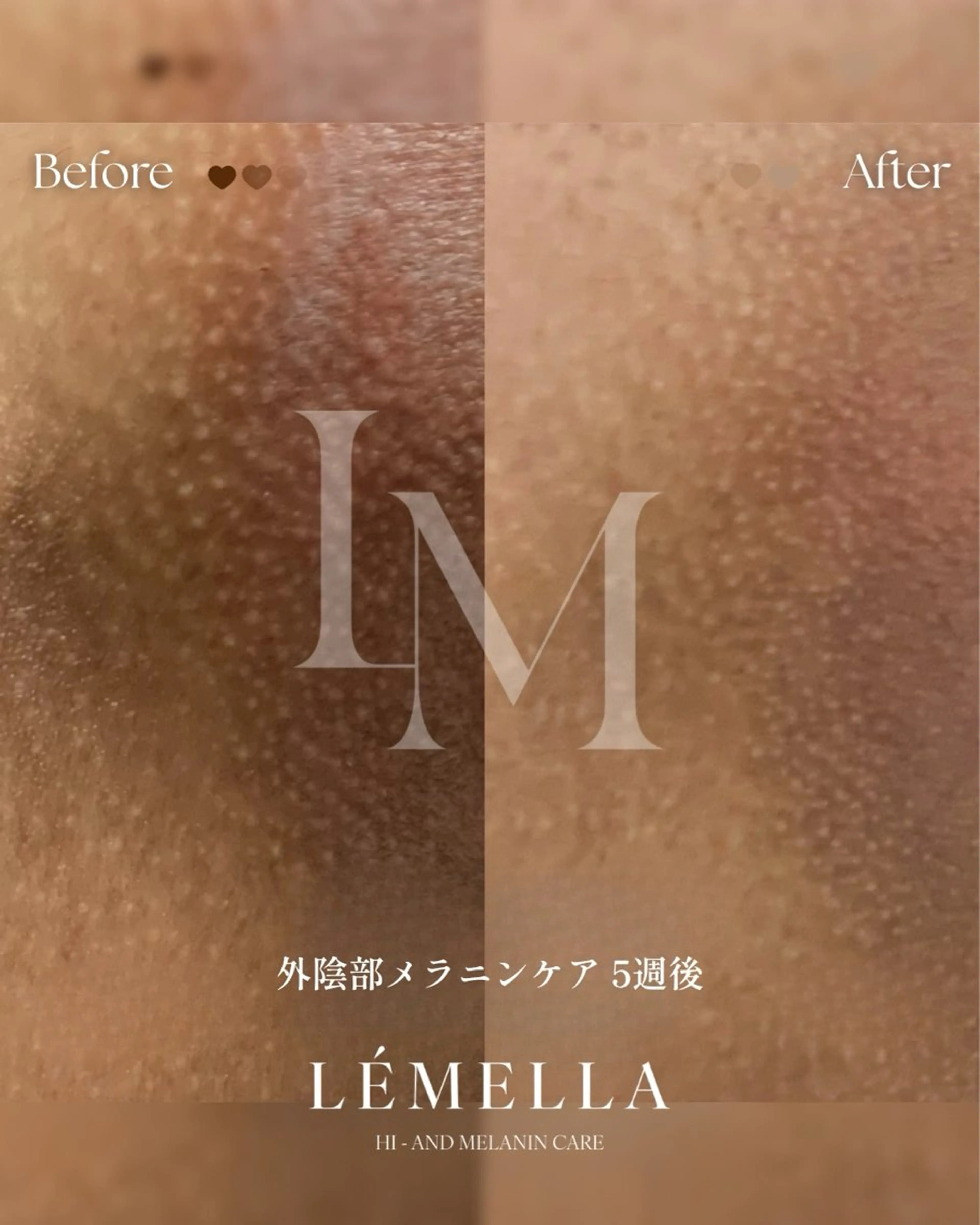 【黒ずみ/メラニンケア】 陰部/たった1回で長年の黒ずみにアプローチ！の写真