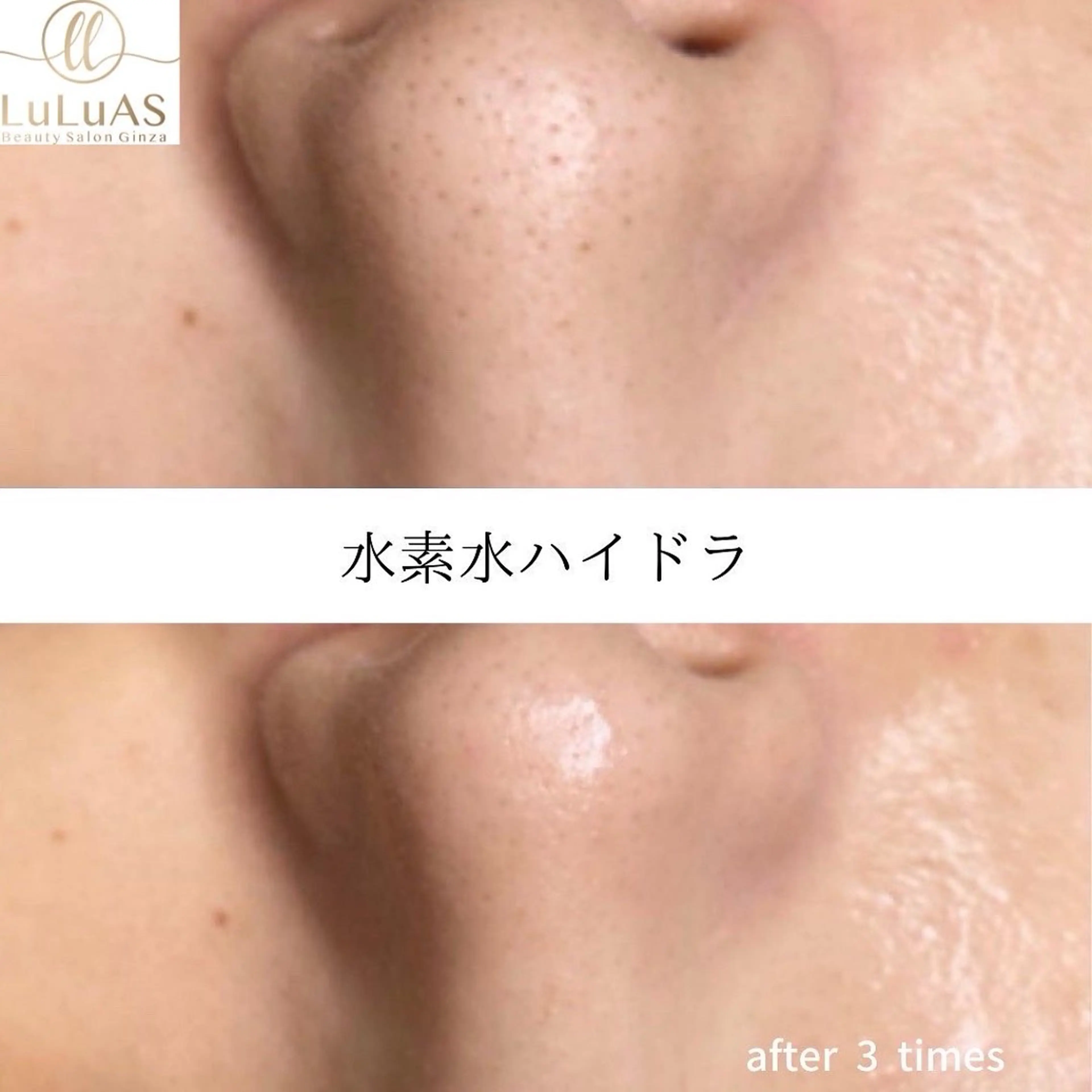 人気No.3🩵【皮脂・角質除去】毛穴洗浄＋首肩小顔リンパ＋美容導入70分🩵黒ずみ・開き毛穴・角栓取り💎の写真