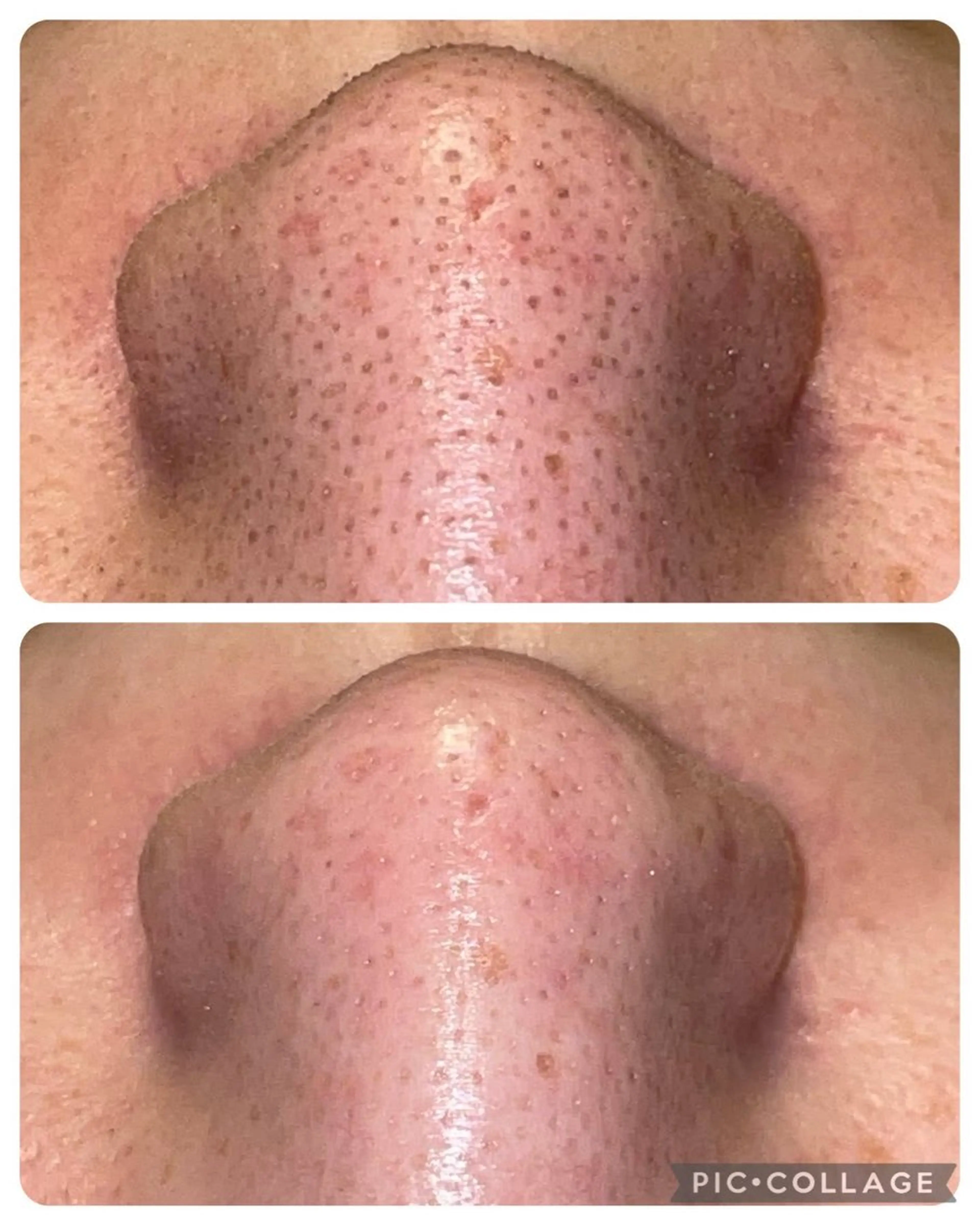 【初回限定】毛穴エクストラクションの写真