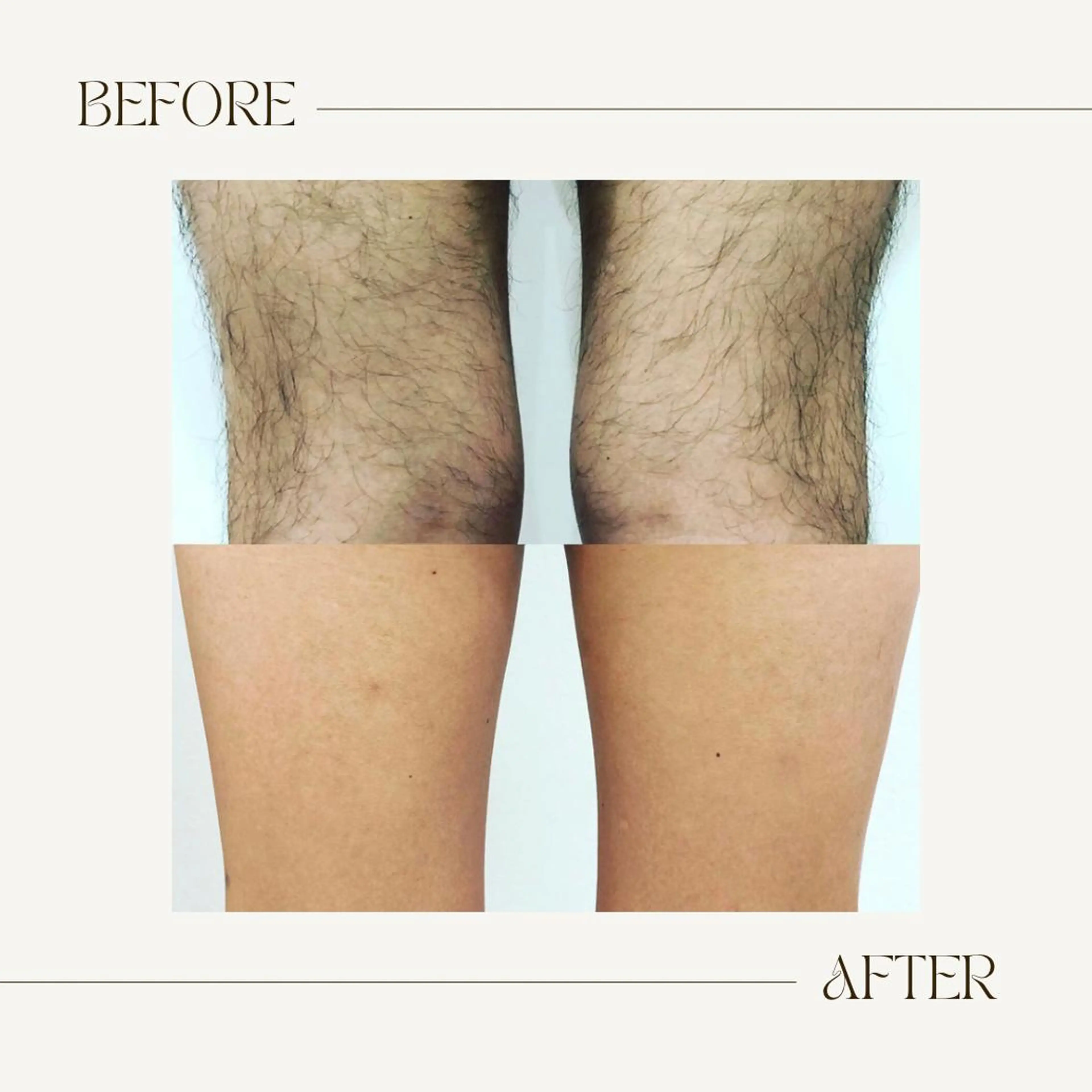 脱毛 脱毛専門サロンELIXIR（ｴﾘｸｻｰ）所属・脱毛&ホワイトニング ELIXIR×ULTのエステ・リラクイメージ