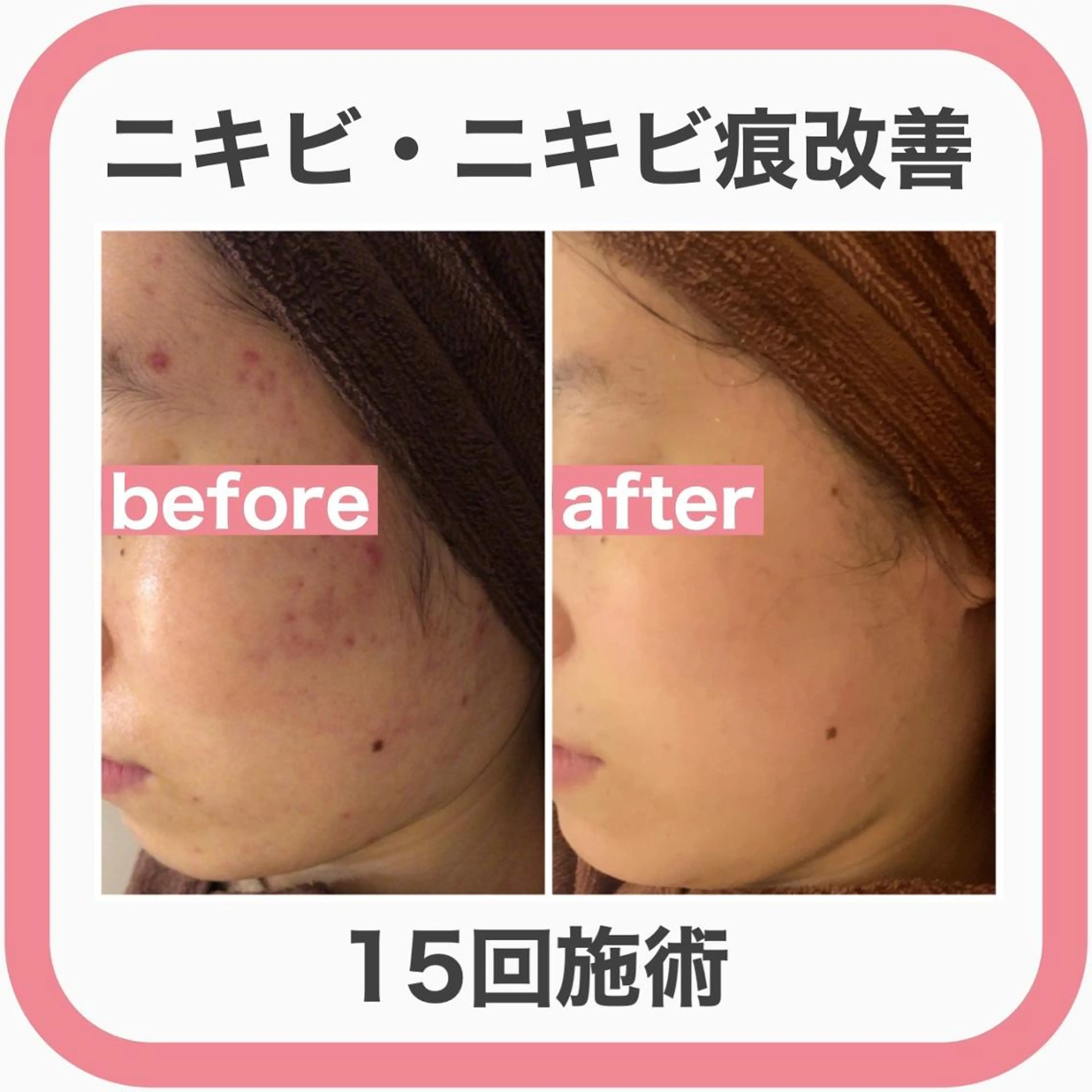 エステ リラク ニキビ特化型エステ 🍓最短で肌質改善のエステ・リラクイメージ