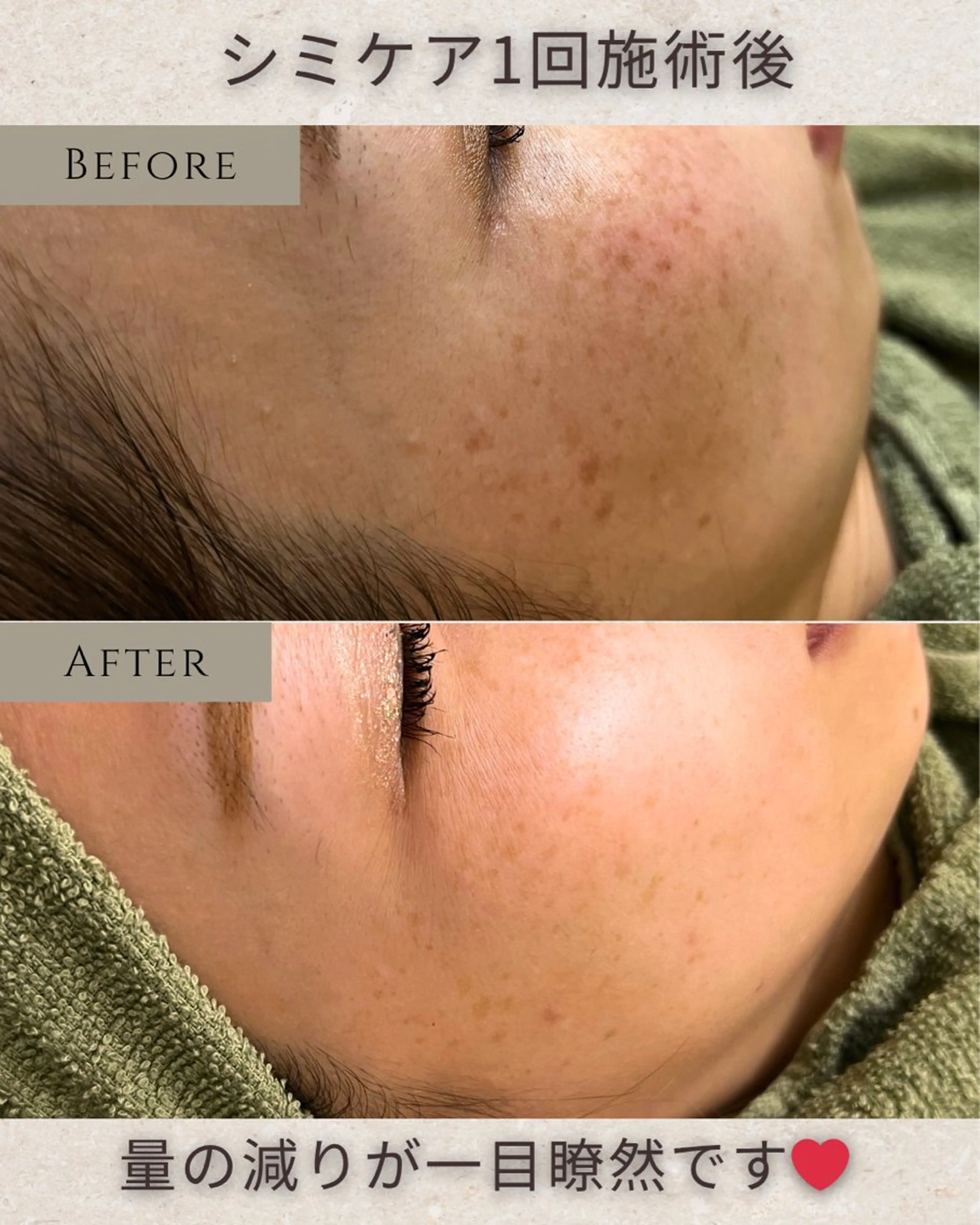 エステ シミ毛穴|眉Wax THE  flowのエステ・リラクイメージ