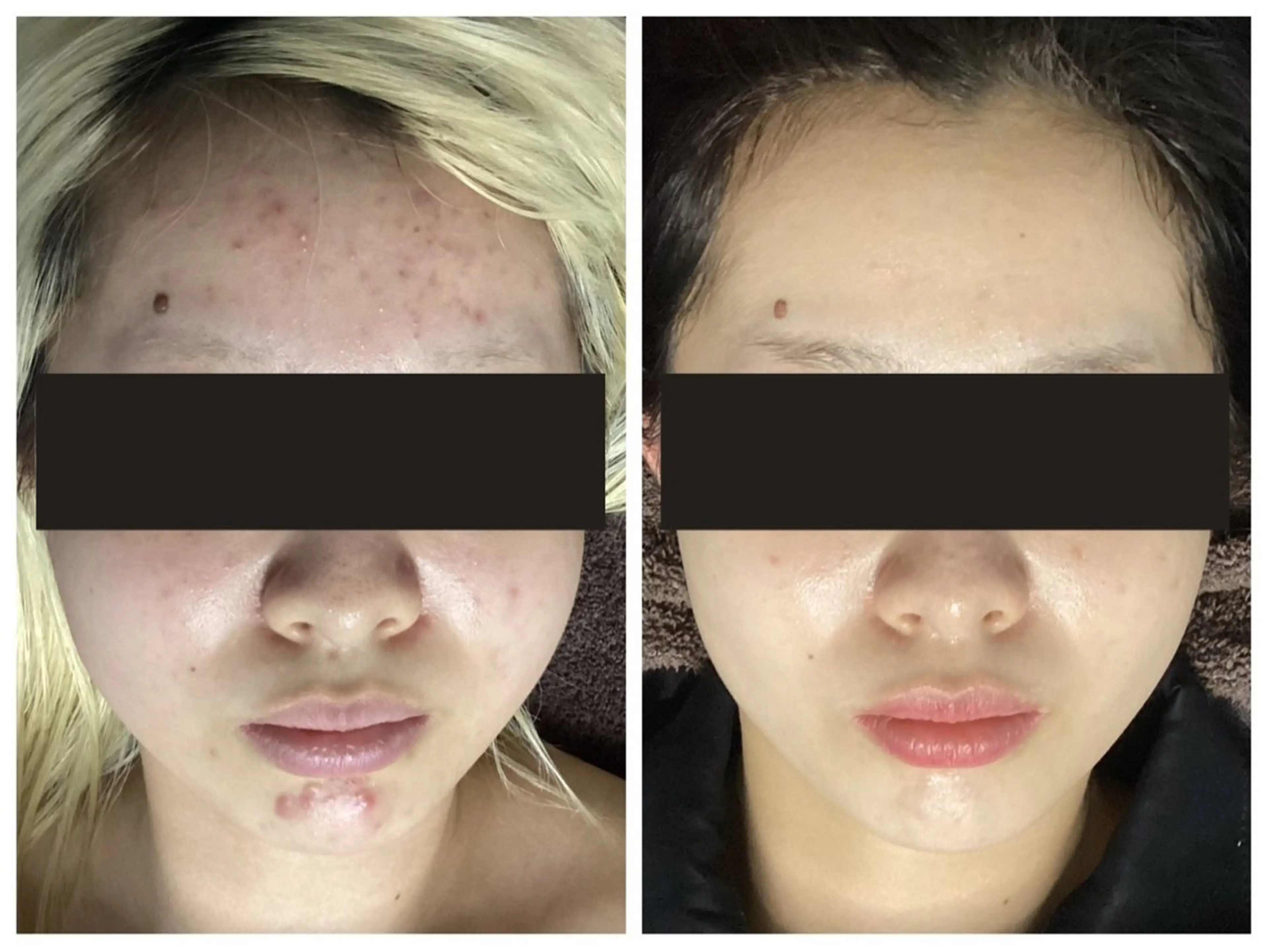 エステ 池袋ニキビ毛穴改善 🌿ハーブピーリングのエステ・リラクイメージ