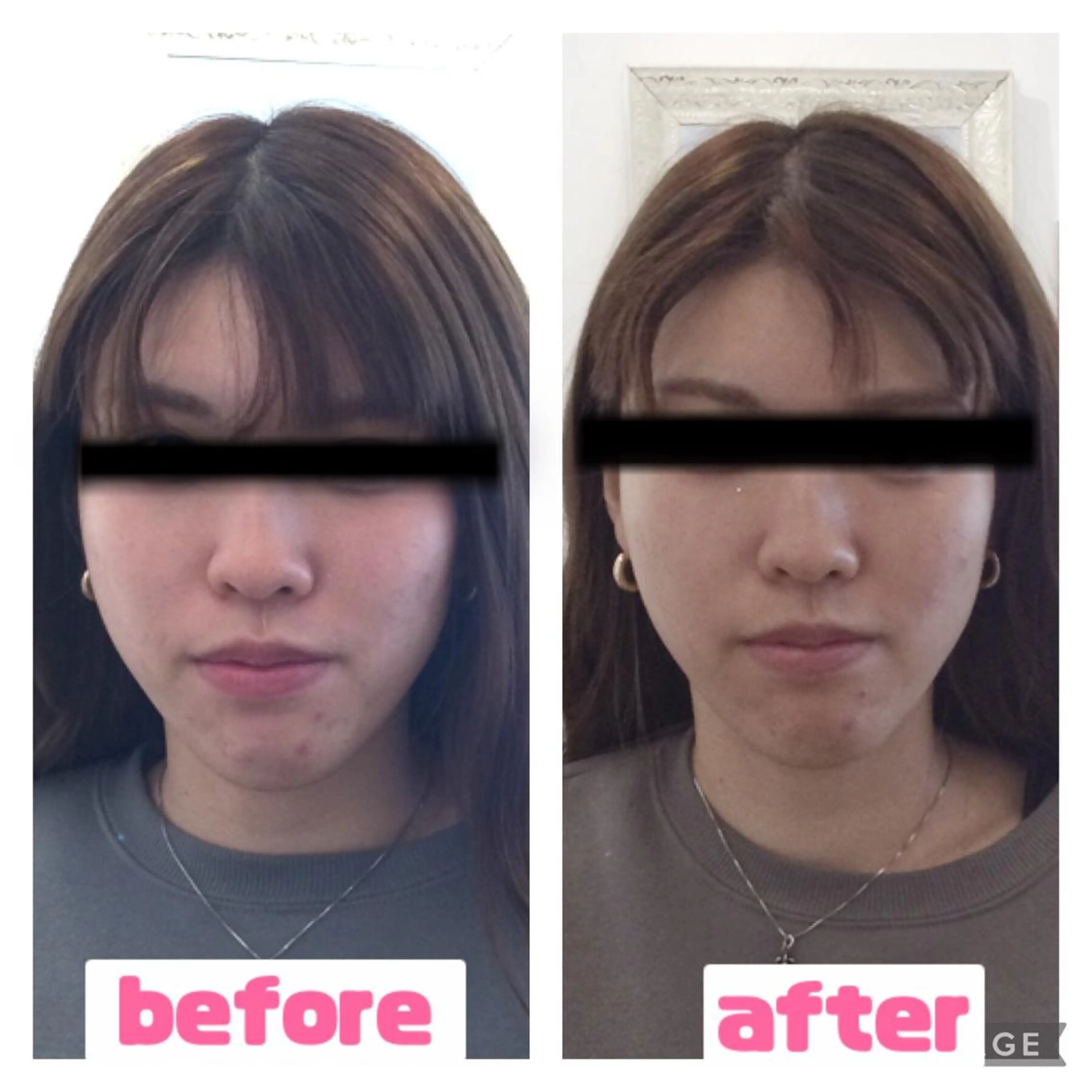 🧡🧡スッキリ小顔美人＋脂肪細胞にアプローチ🔥→マッサージ＋鎮静パック🧡🧡の写真