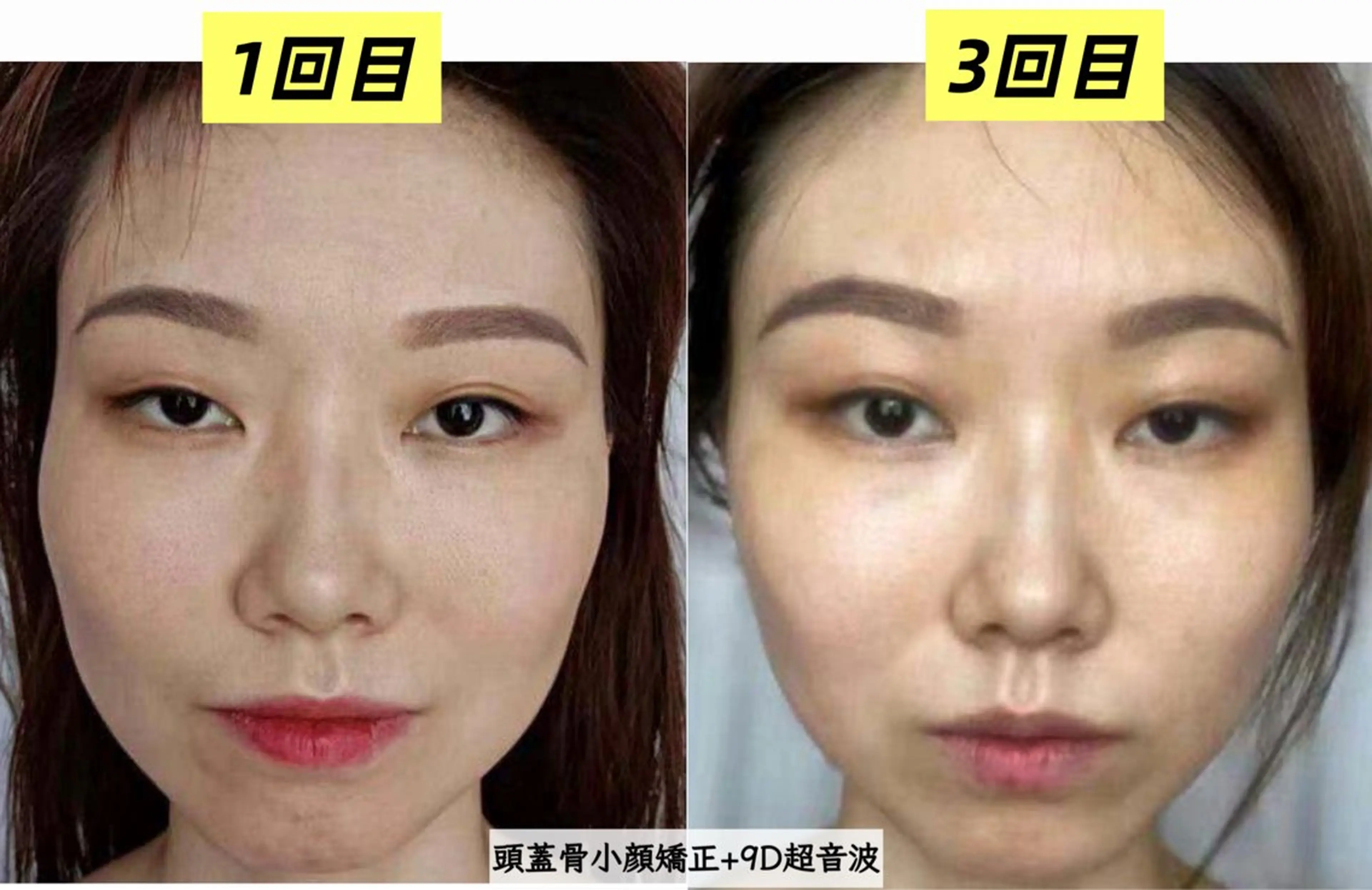 速攻小顔【頭蓋骨小顔矯正+9D超音波】　45分の写真