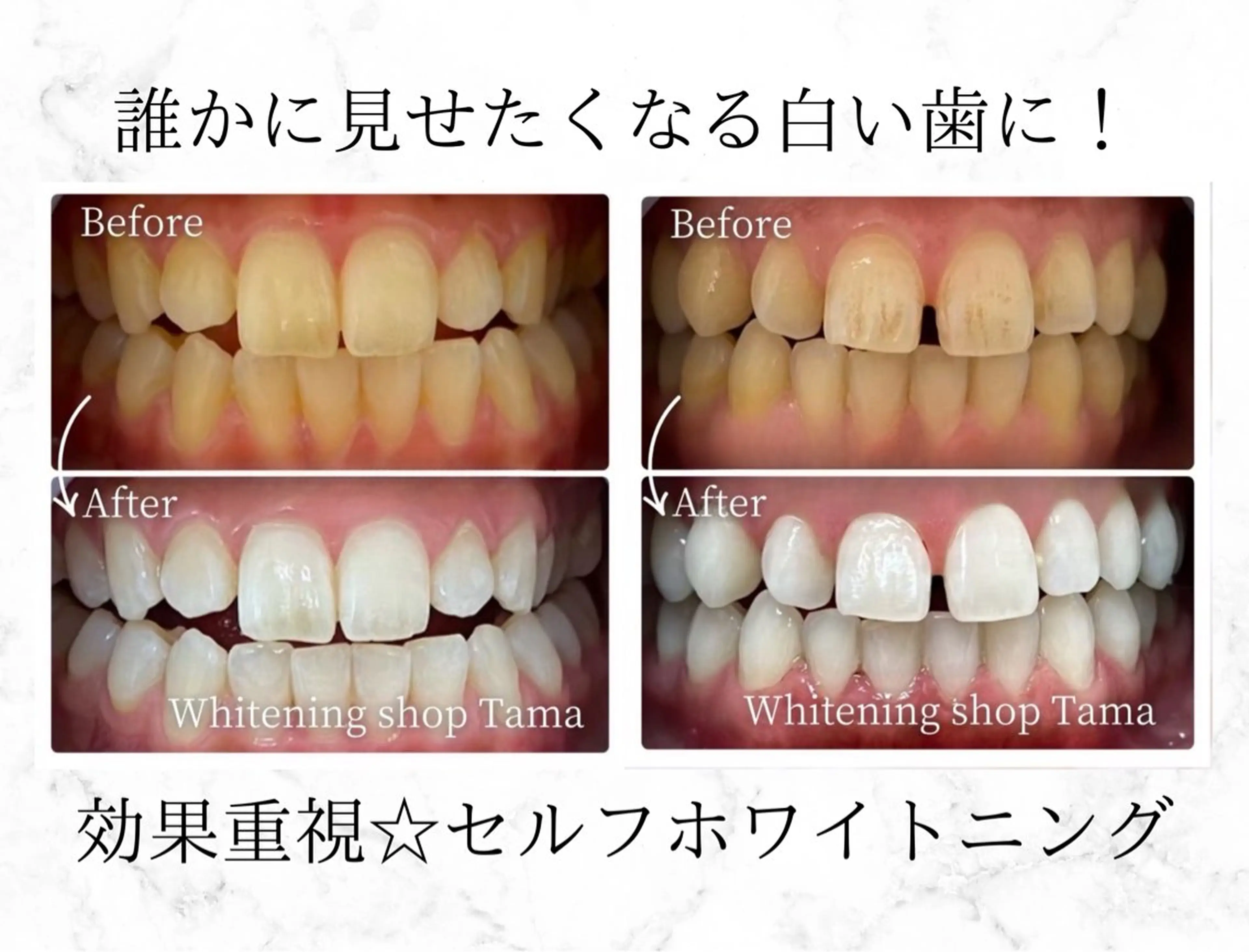【🈹ホワイトニングデビュー応援📣】通常より長い45分照射で圧倒的効果🦷¥2,500初回でも1からスタッフがサポートの写真