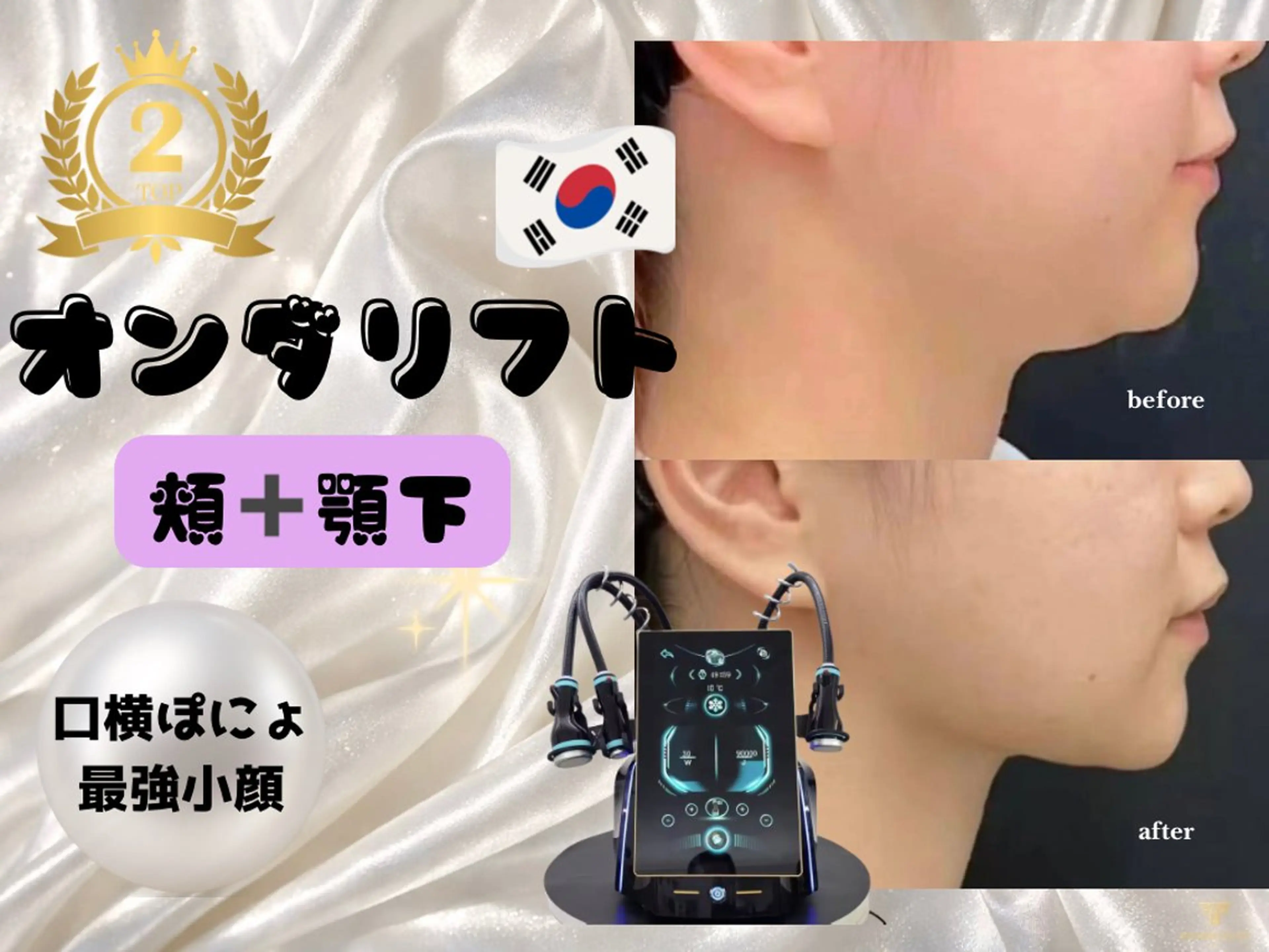 オンダリフト30分｜頬~顎下80kj~140kjの写真