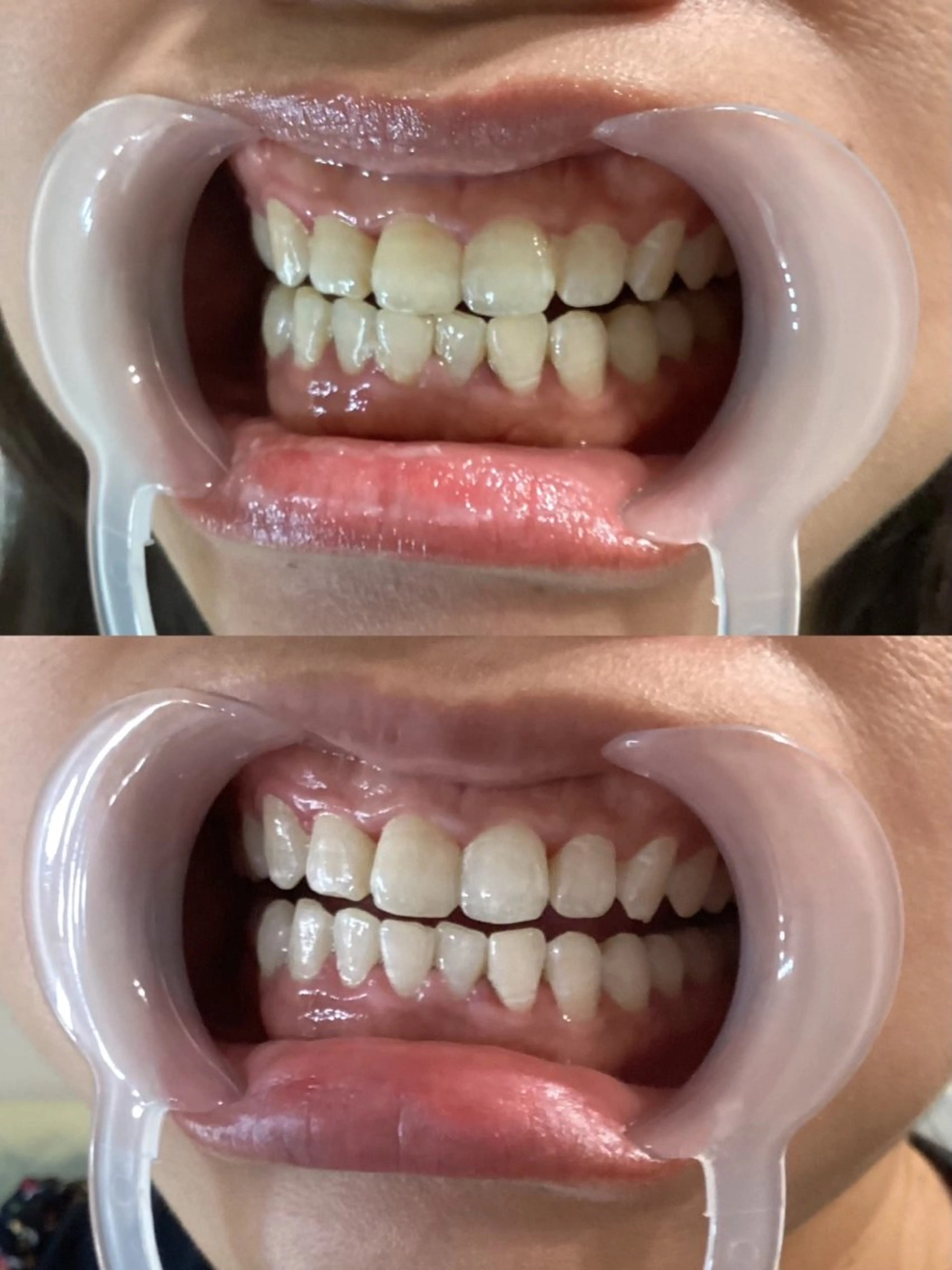 セルフホワイトニングハイパワ-2倍で時短!85W8分×2回の写真