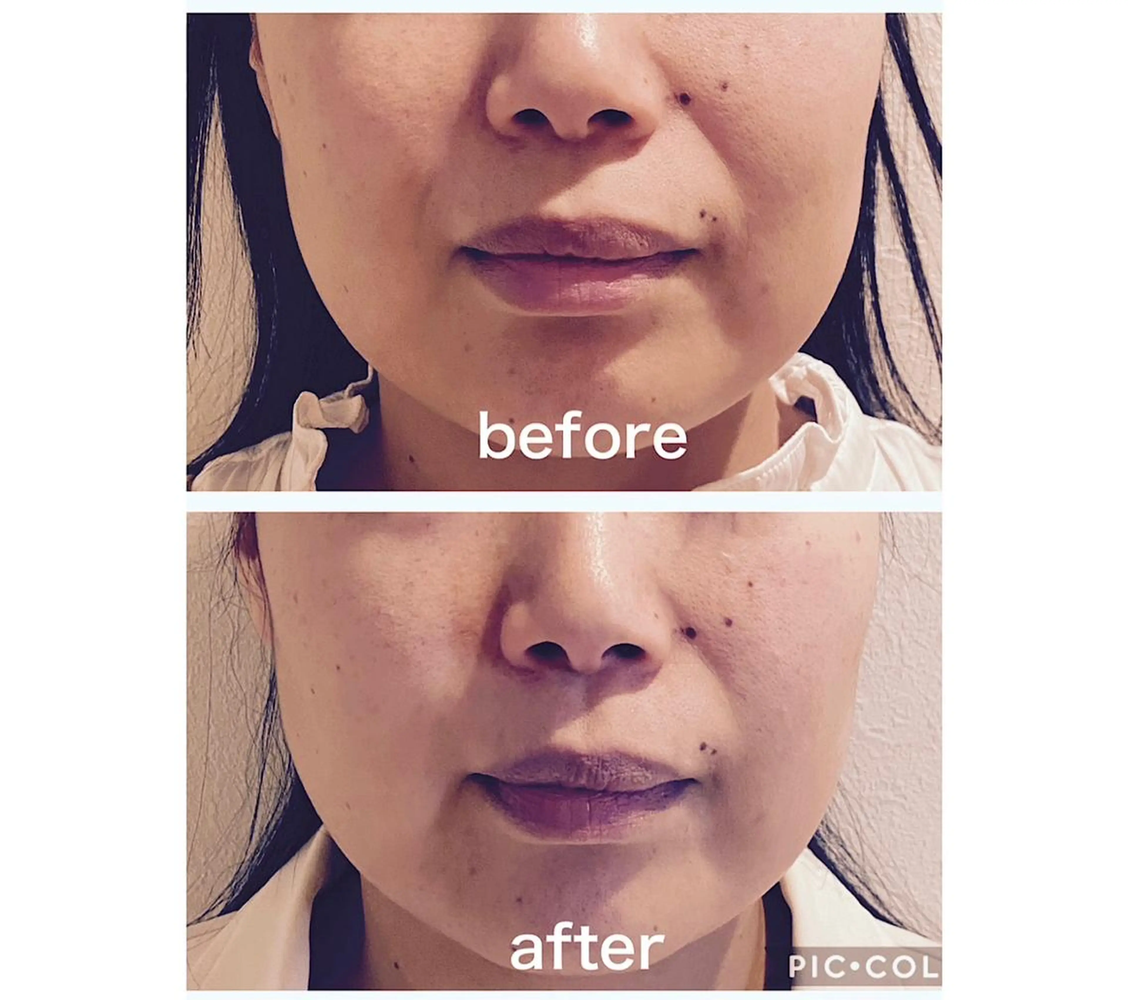 医療レベルの美容機器グロッティしわたるみケアコース　自信を持ってマスクをはずしたくなります！の写真