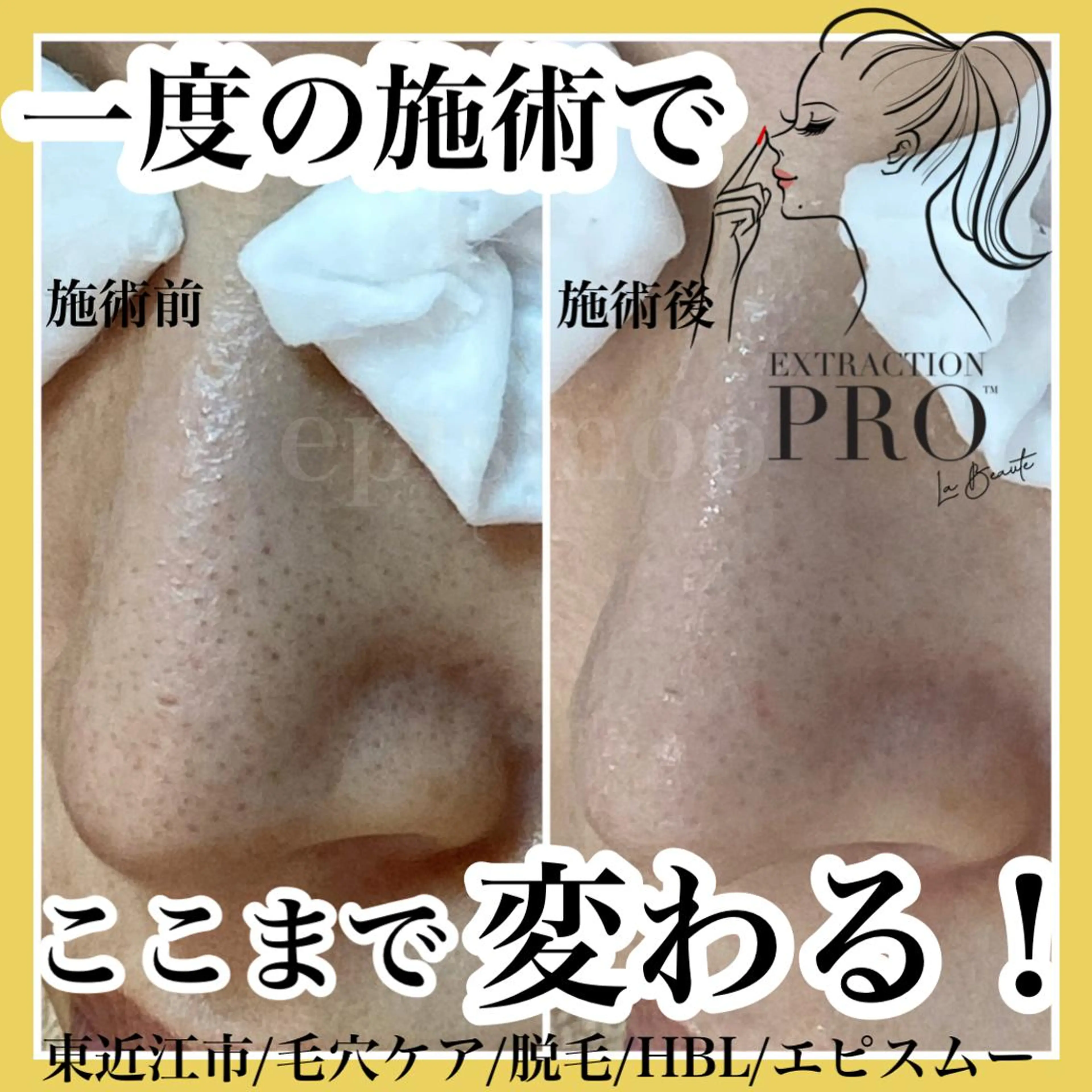 epismoo 脱毛/HBL/毛穴の眉毛・アイブロウイメージ