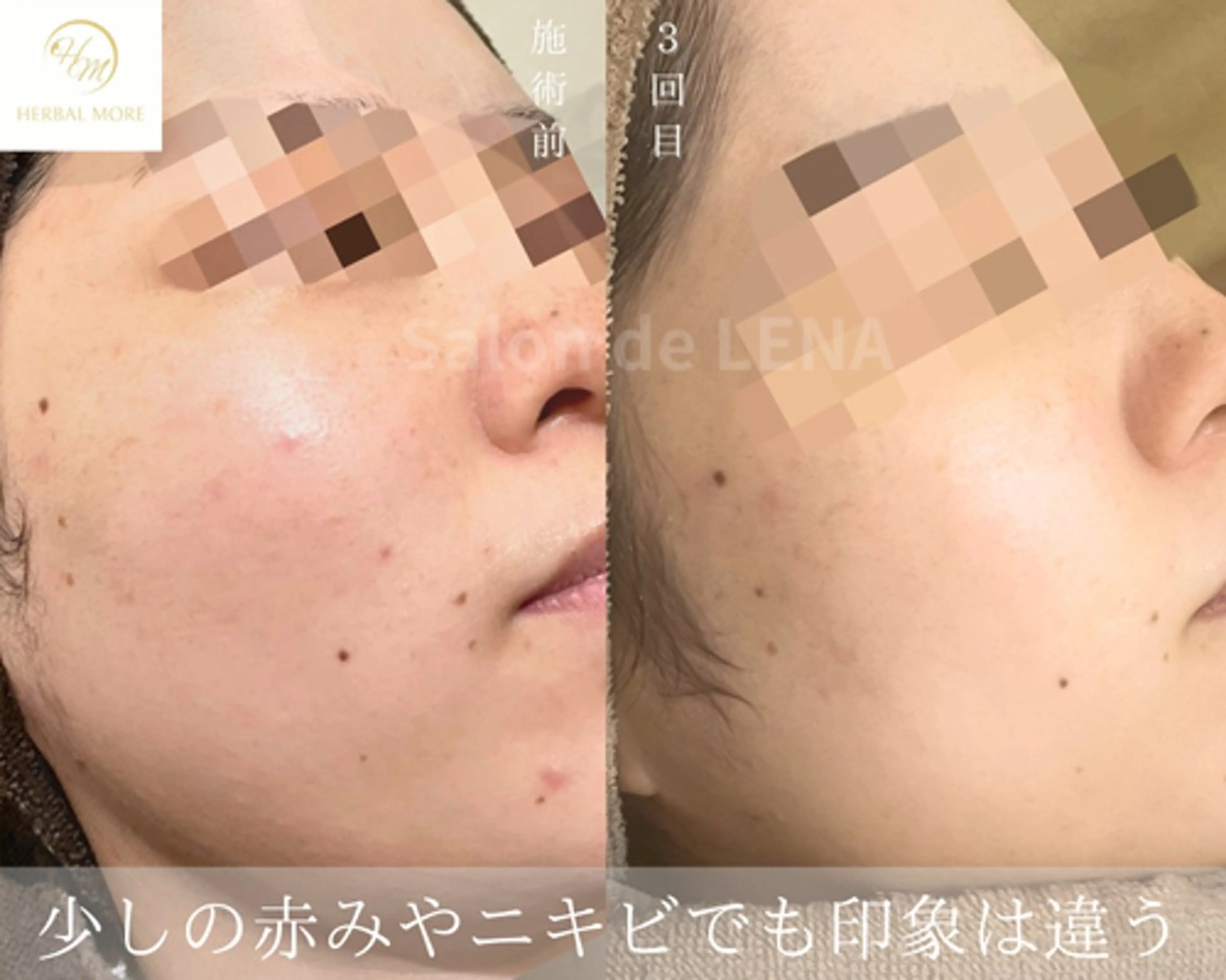 エステ サロンドレナ名駅店所属・ハーブピーリング専門 サロンドレナ平岡のエステ・リラクイメージ