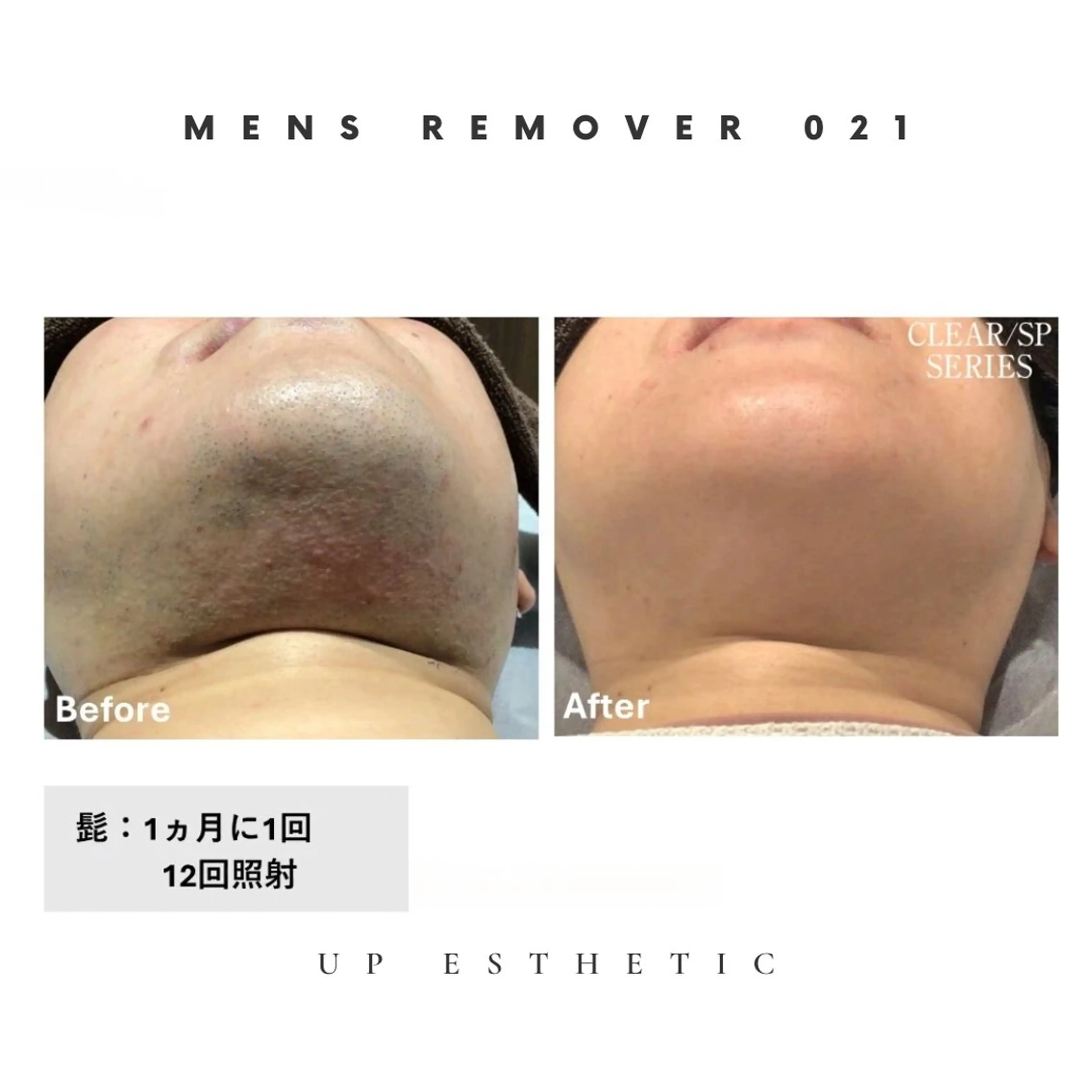 メンズ アイブロウ メンズアイブロウ 眉毛ワックス脱毛 脱毛 ウプエステティック所属・韓国肌管理 ウプエステティックのエステ・リラクイメージ