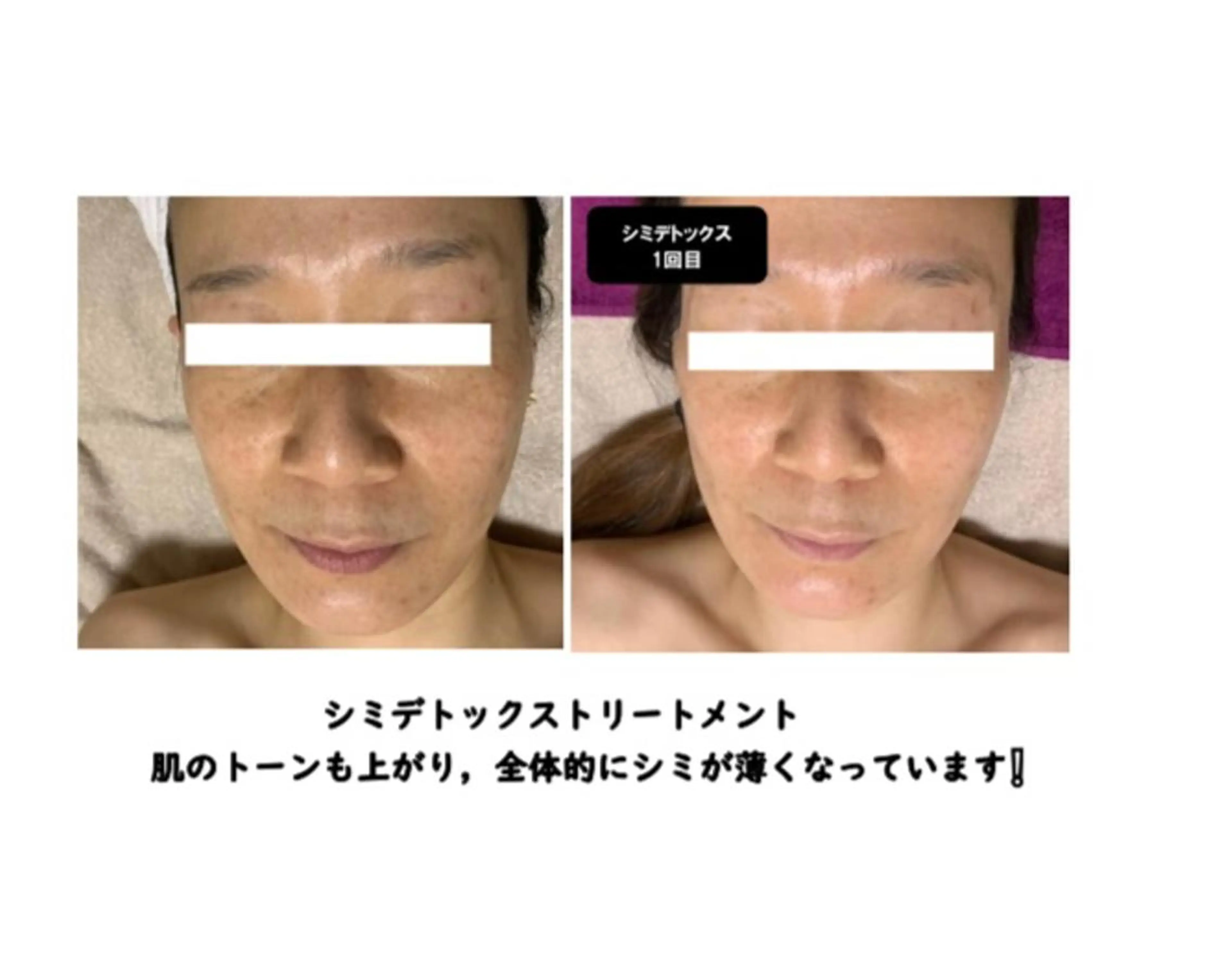 シミデトックストリートメント✨初回限定　6,000円✨の写真