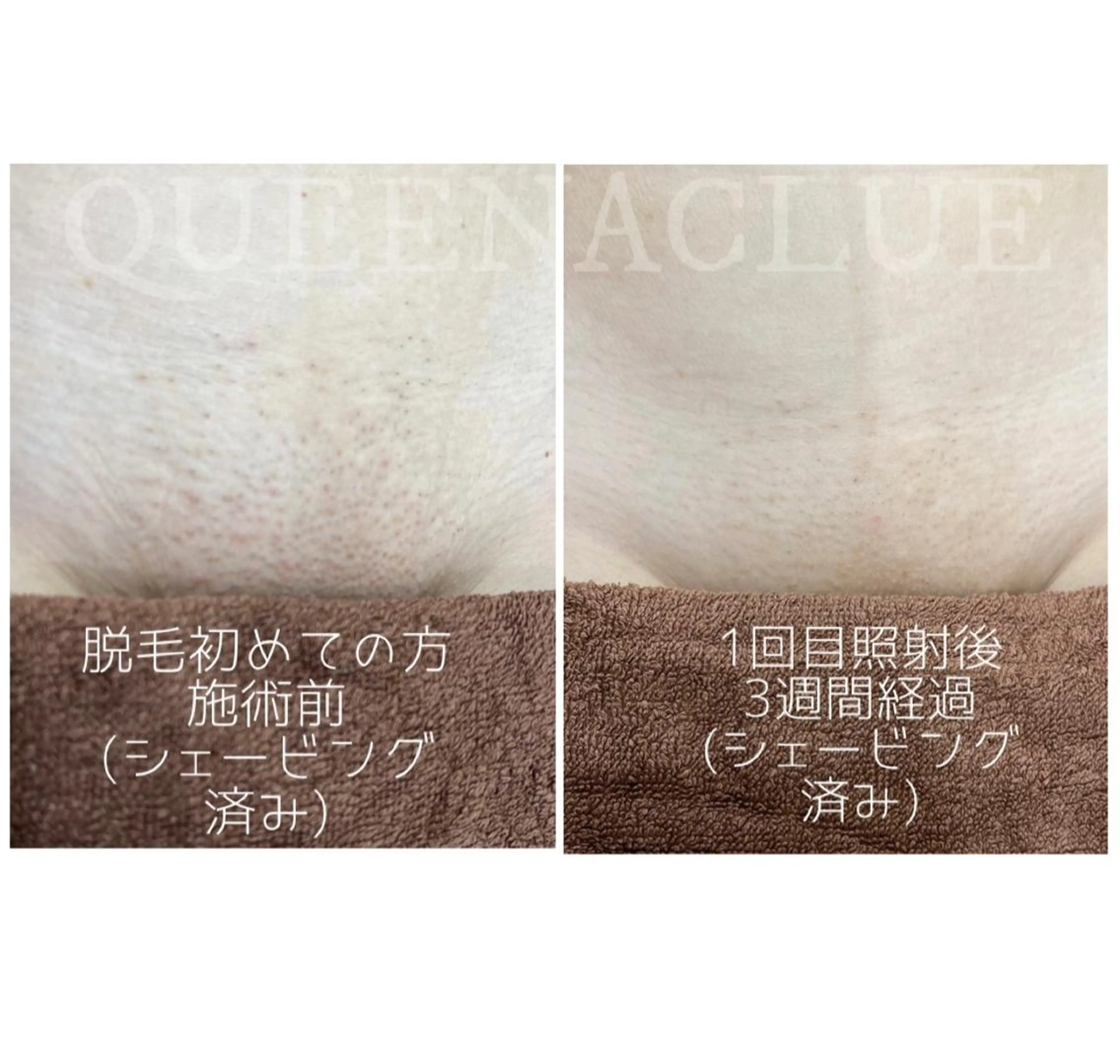 脱毛 毛穴改善/脱毛 ネイル　川上久仁子のエステ・リラクイメージ