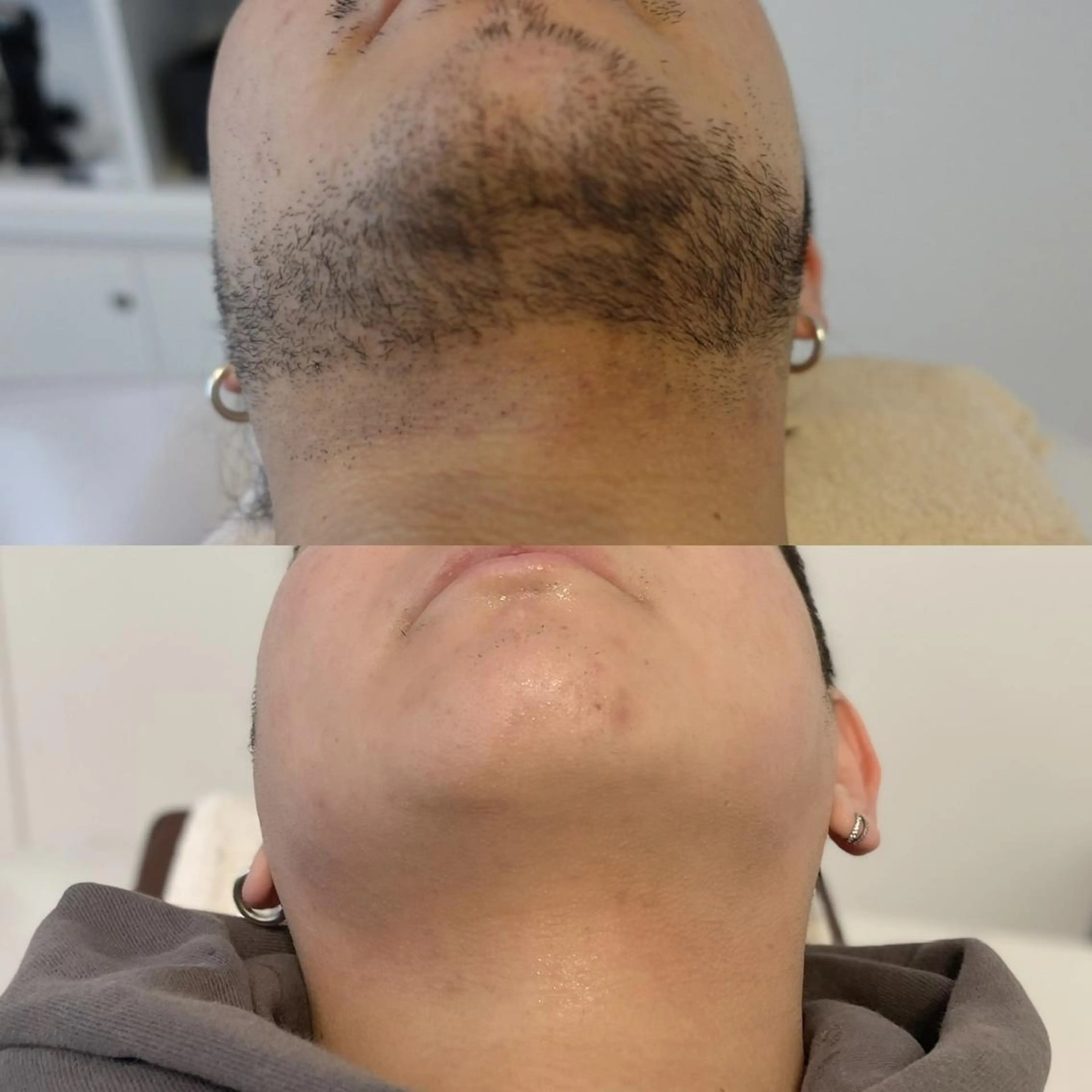 \3回目以降/Mパーツ脱毛【全顔・膝下・膝上・肘下・肘上・胸・腹・ヒップ】※ひとつ選択の写真