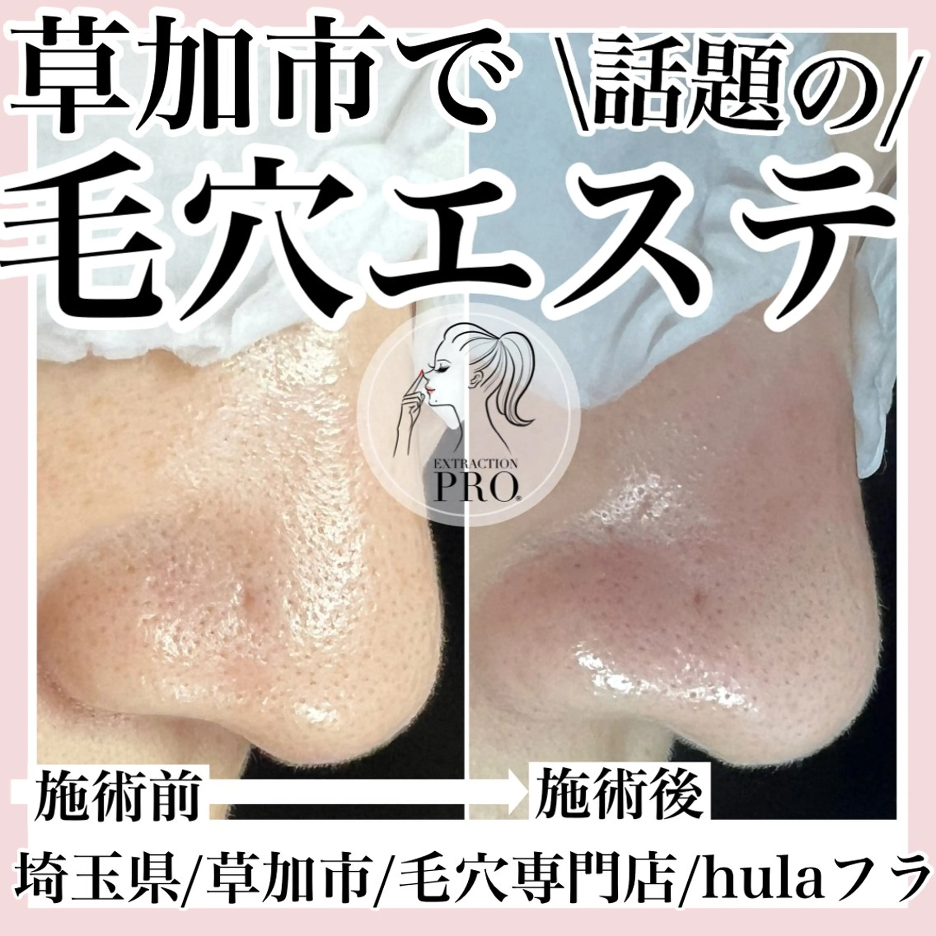 毛穴改善コース(毛穴エクストラクションプロ/毛穴洗浄のみ)マッサージは付きません。の写真