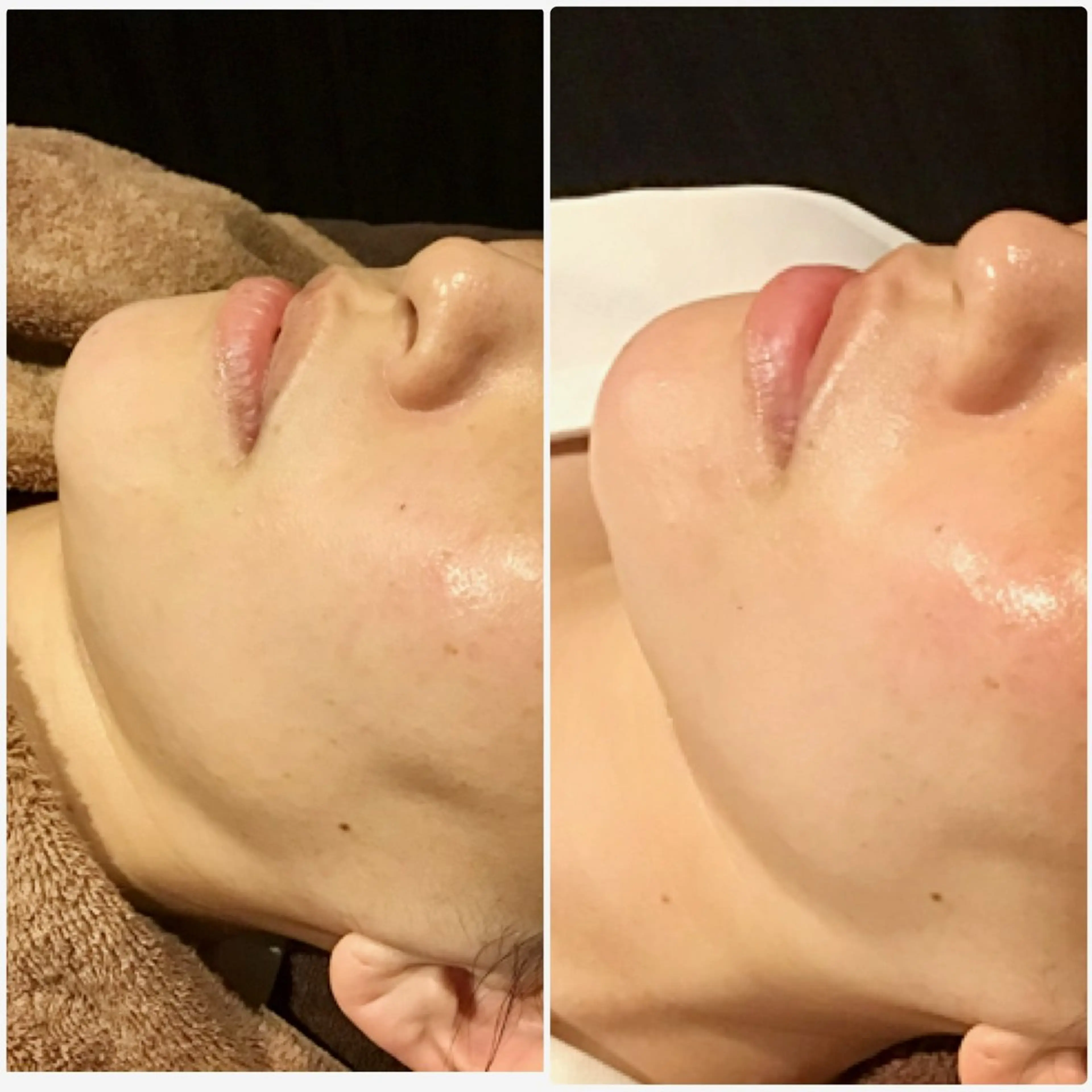 特許取得生コラーゲン✨エイジングケアフェイシャルの写真