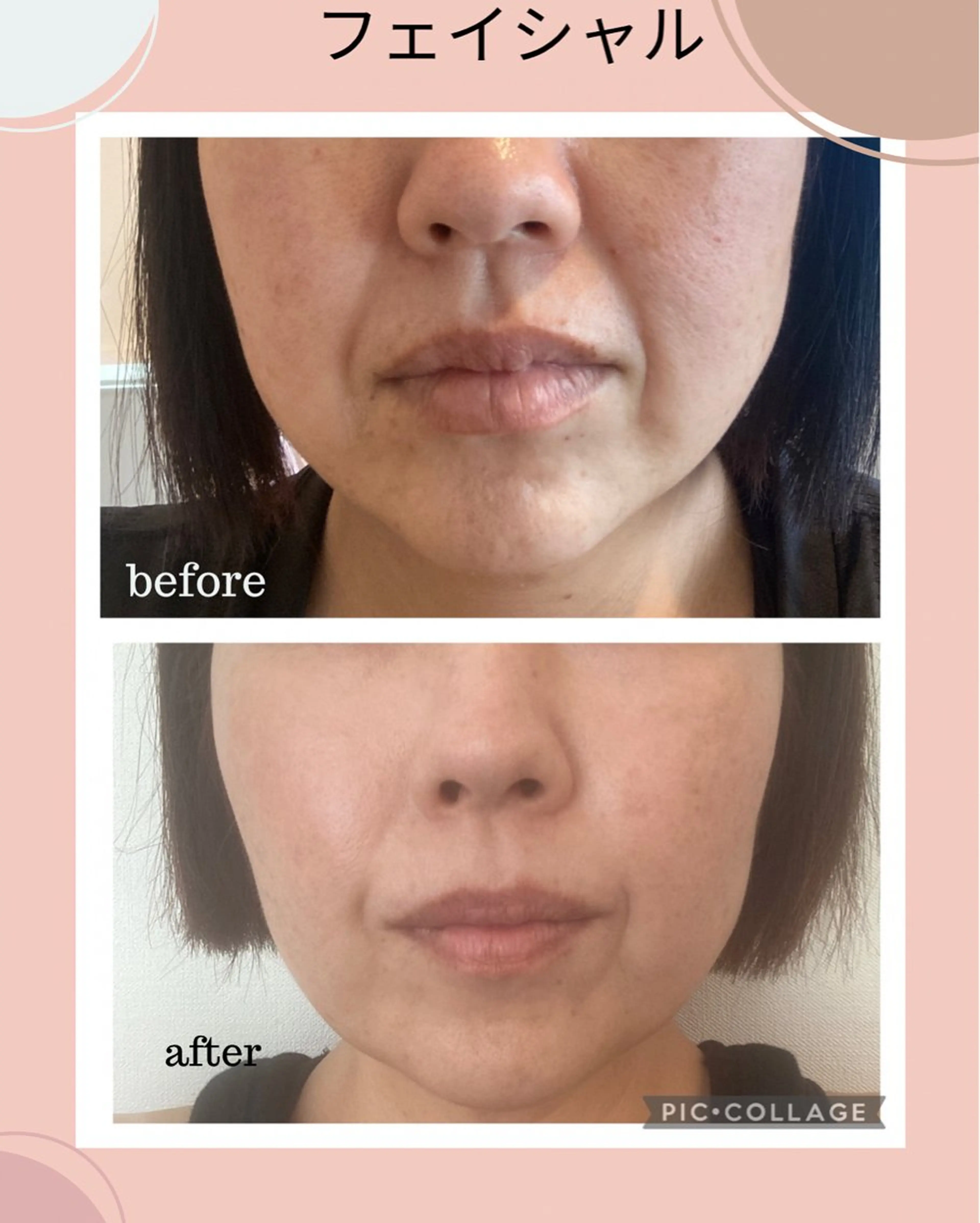 全6回❣️造顔小顔リンパ❤️✨たるみ・ほうれい線・しわ改善💪の写真