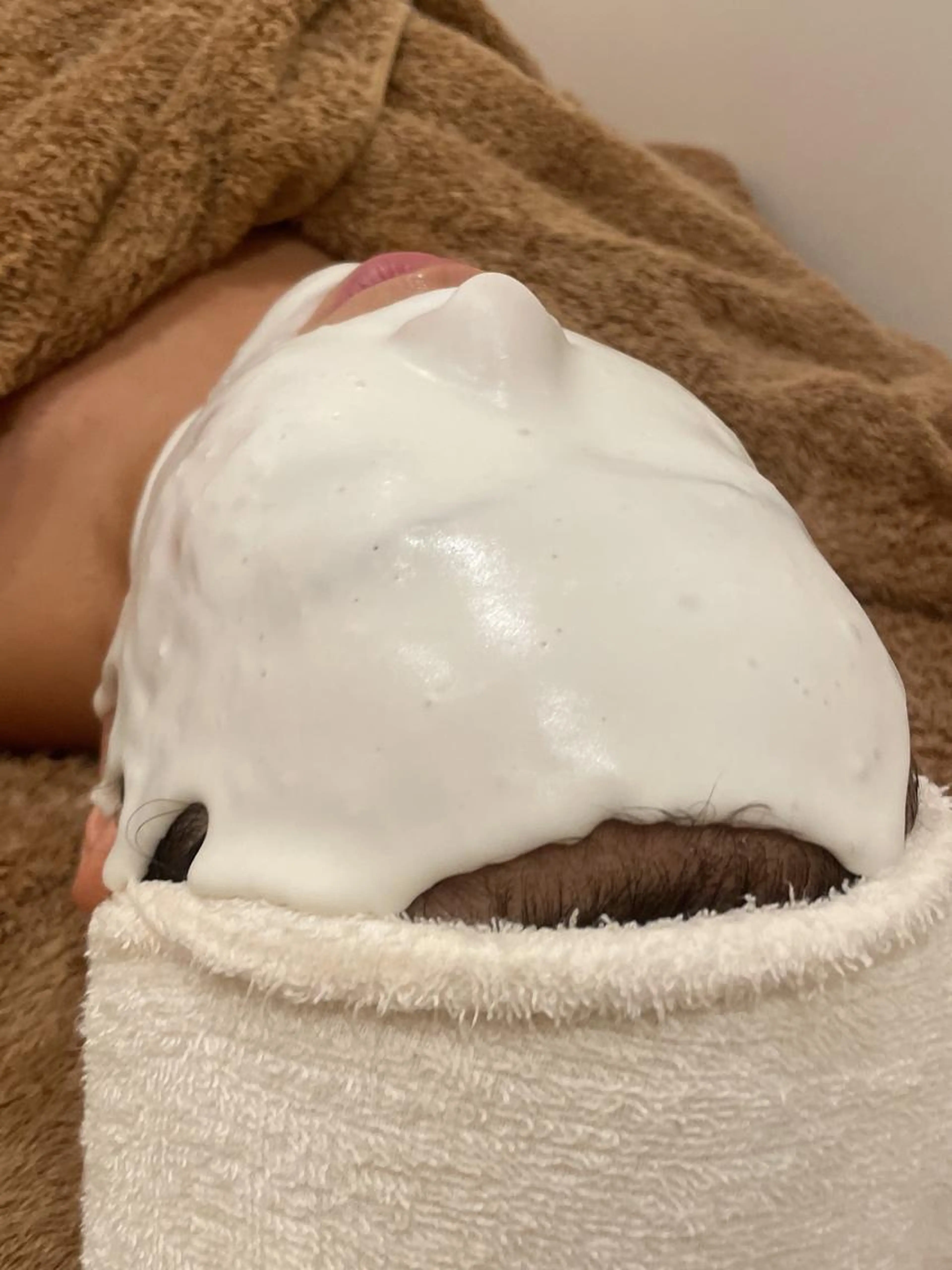 🤍日焼け後のケア、ニキビ跡、シミにおススメパック🤍『アドバンスコース+ブライトニングパック』の写真