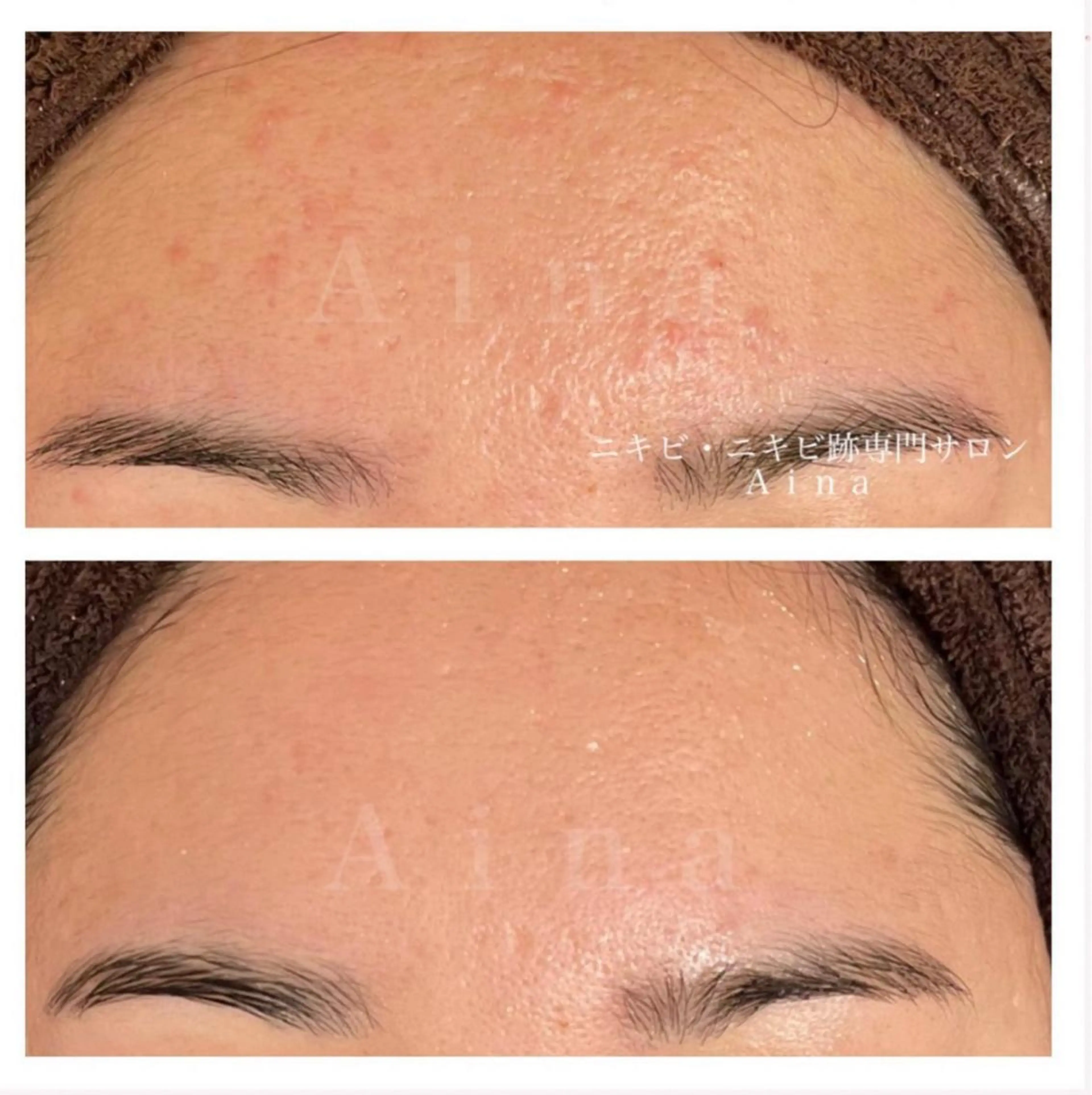 セミロング パーマ ヘアアレンジ メンズ キッズ ネイル マツエク・マツパ アイブロウ 卒業式のヘアスタイル 卒業式 エステ リラク ニキビ跡専門サロン Ainaのエステ・リラクイメージ