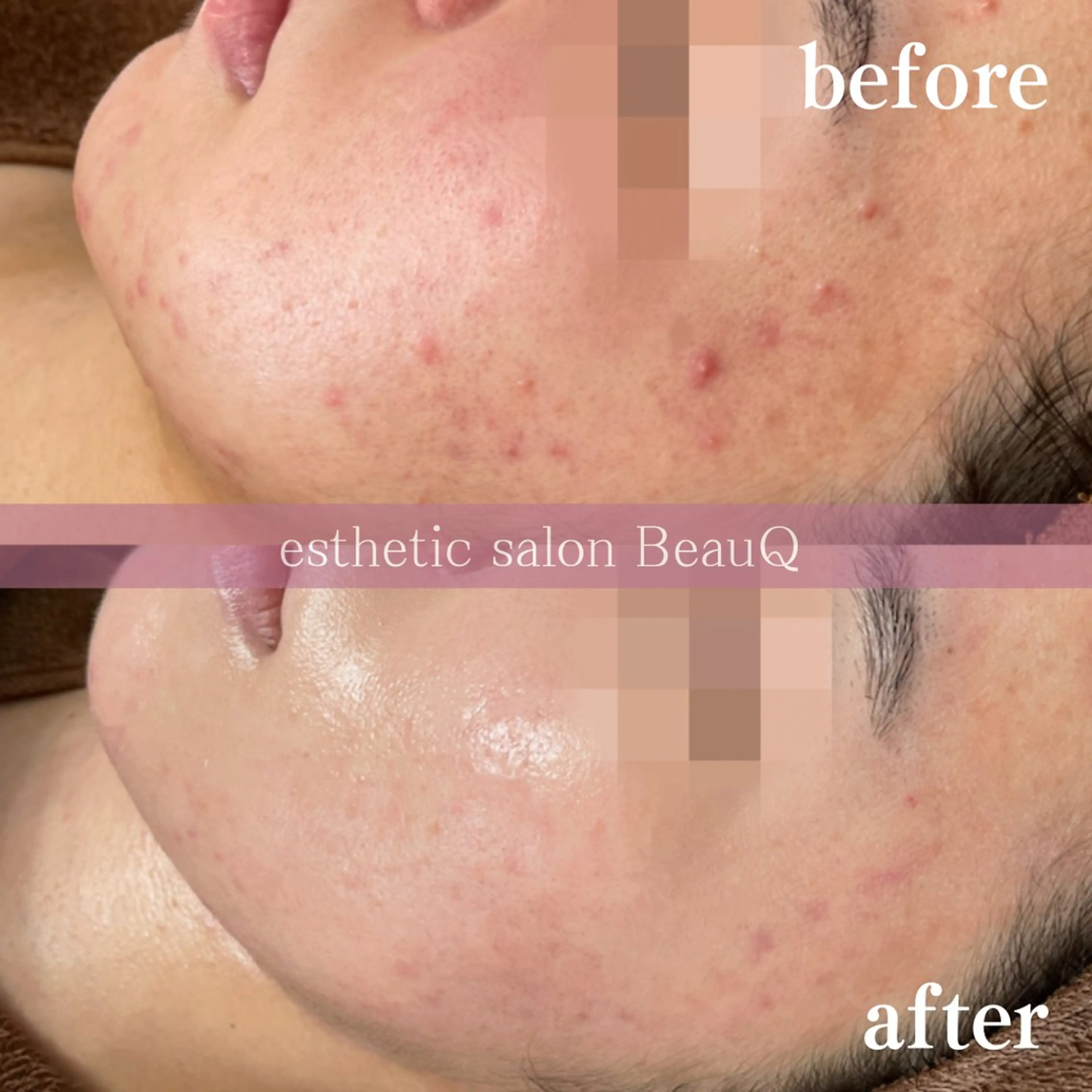 肌質改善/ブライダル 水上百華のエステ・リラクイメージ