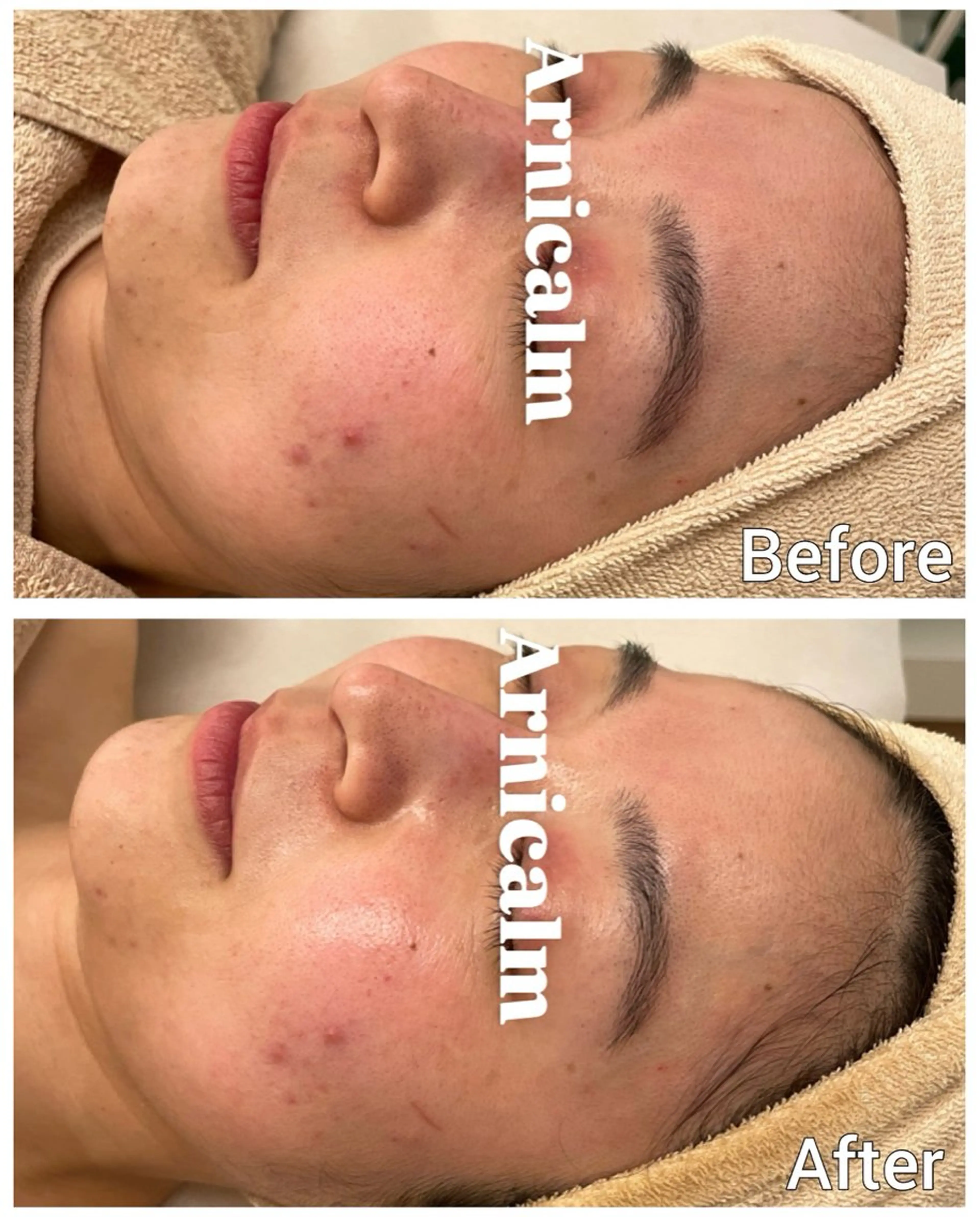 エステ ハーブピーリング 肌再生ピーリング/のエステ・リラクイメージ