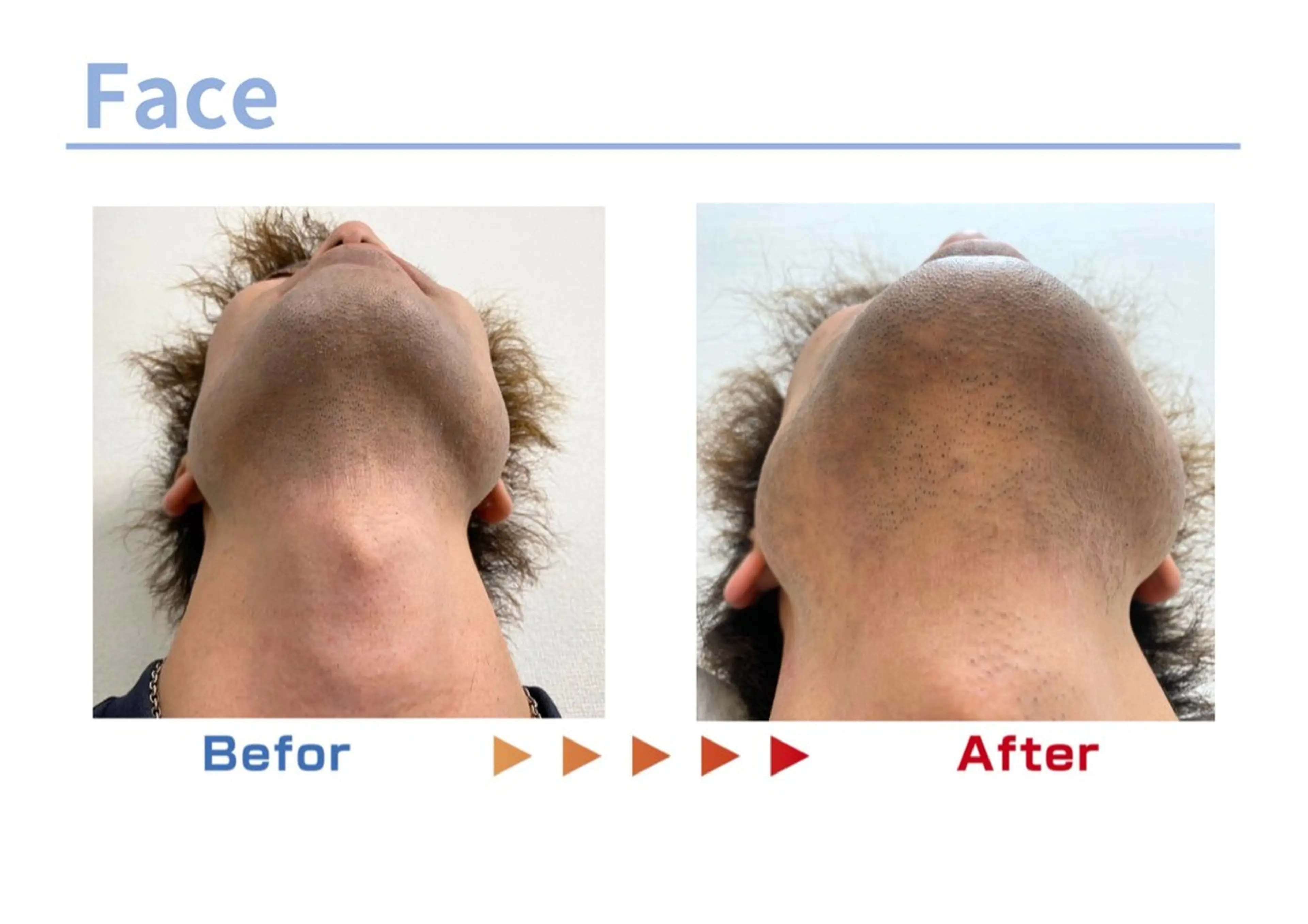 メンズ セルフ脱毛/美尻イス キングスサロン熊本のエステ・リラクイメージ