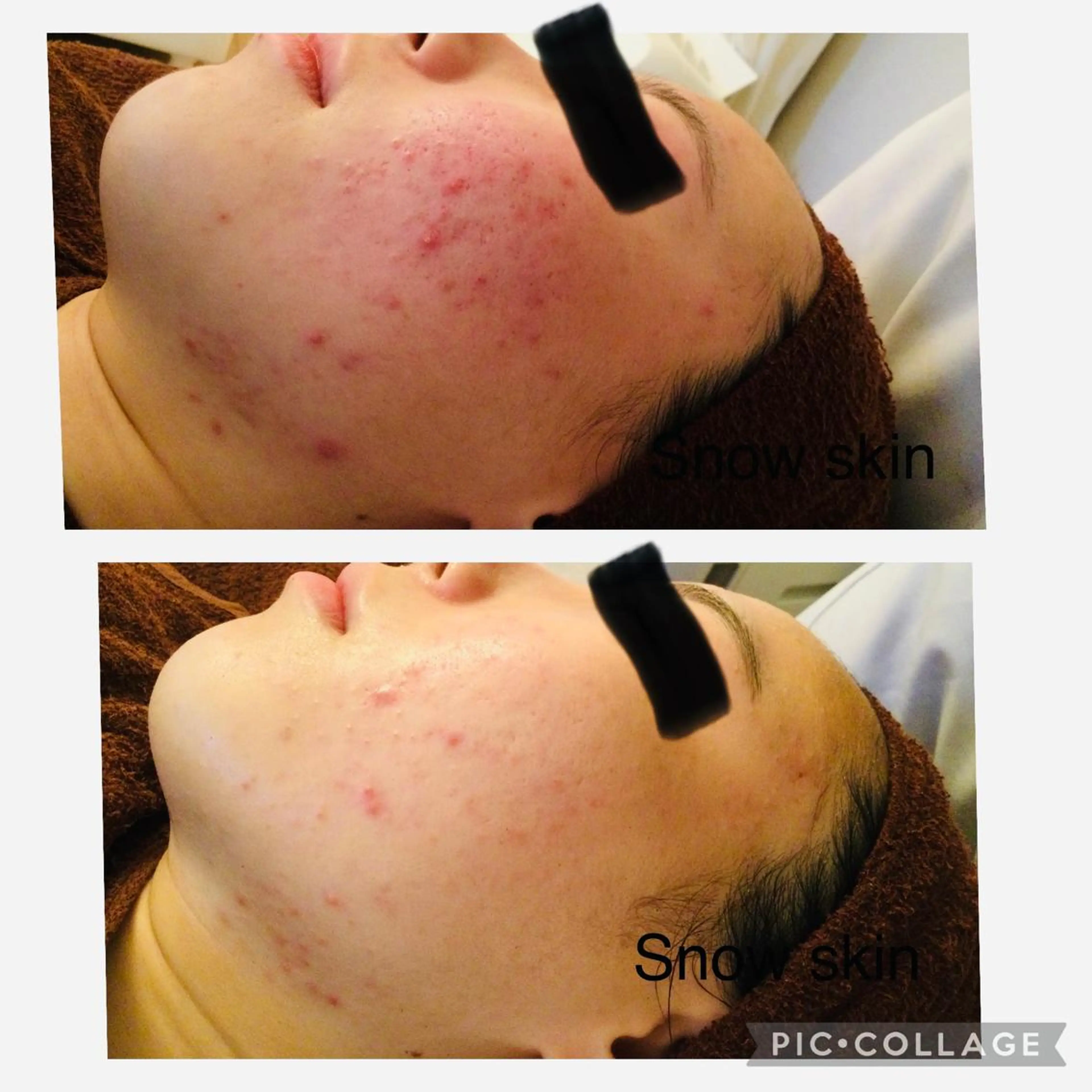 エステ リラク ニキビ/肌質改善専門 Snow skinのエステ・リラクイメージ