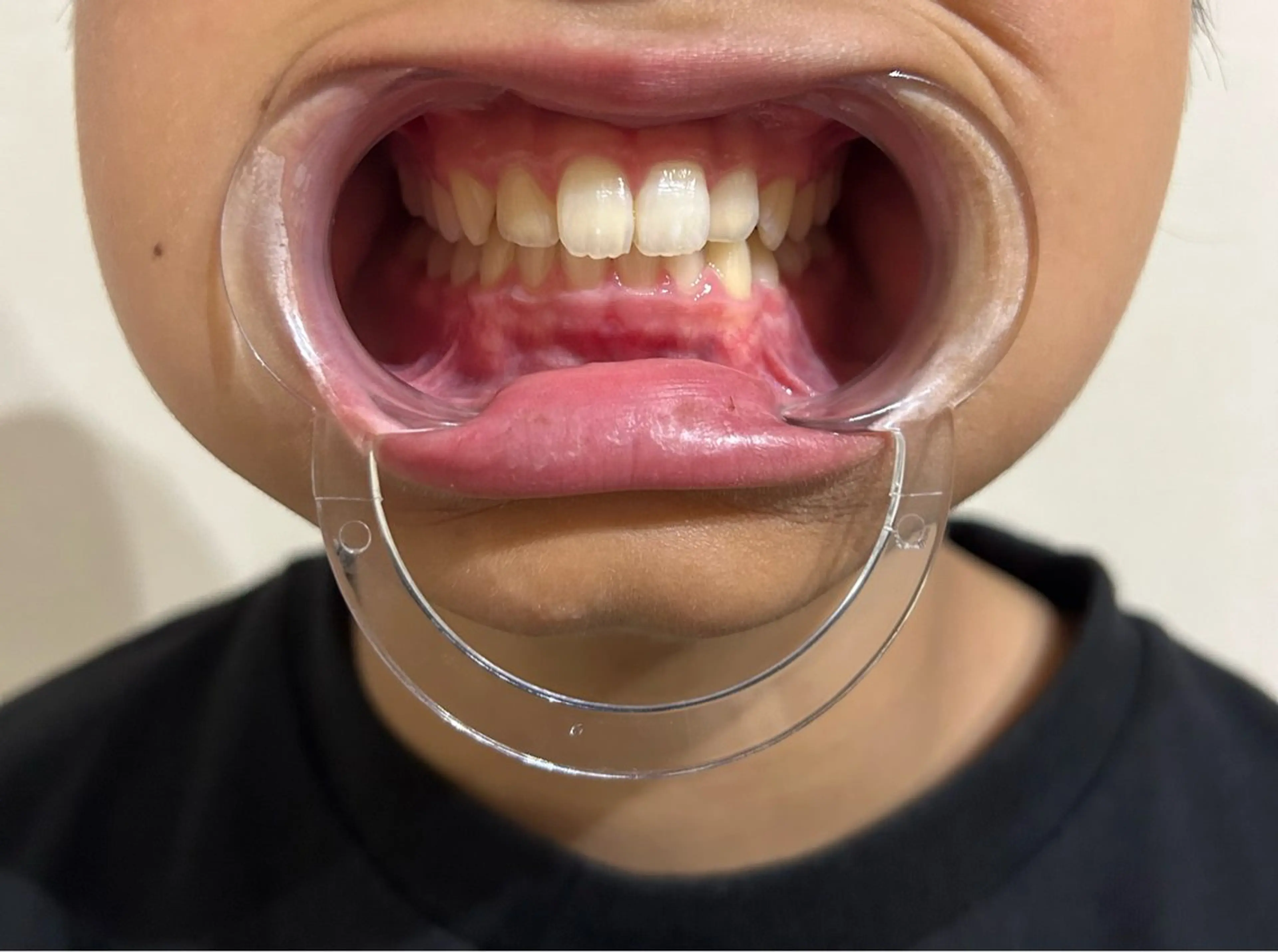 【学割メニュー】セルフホワイトニングの写真