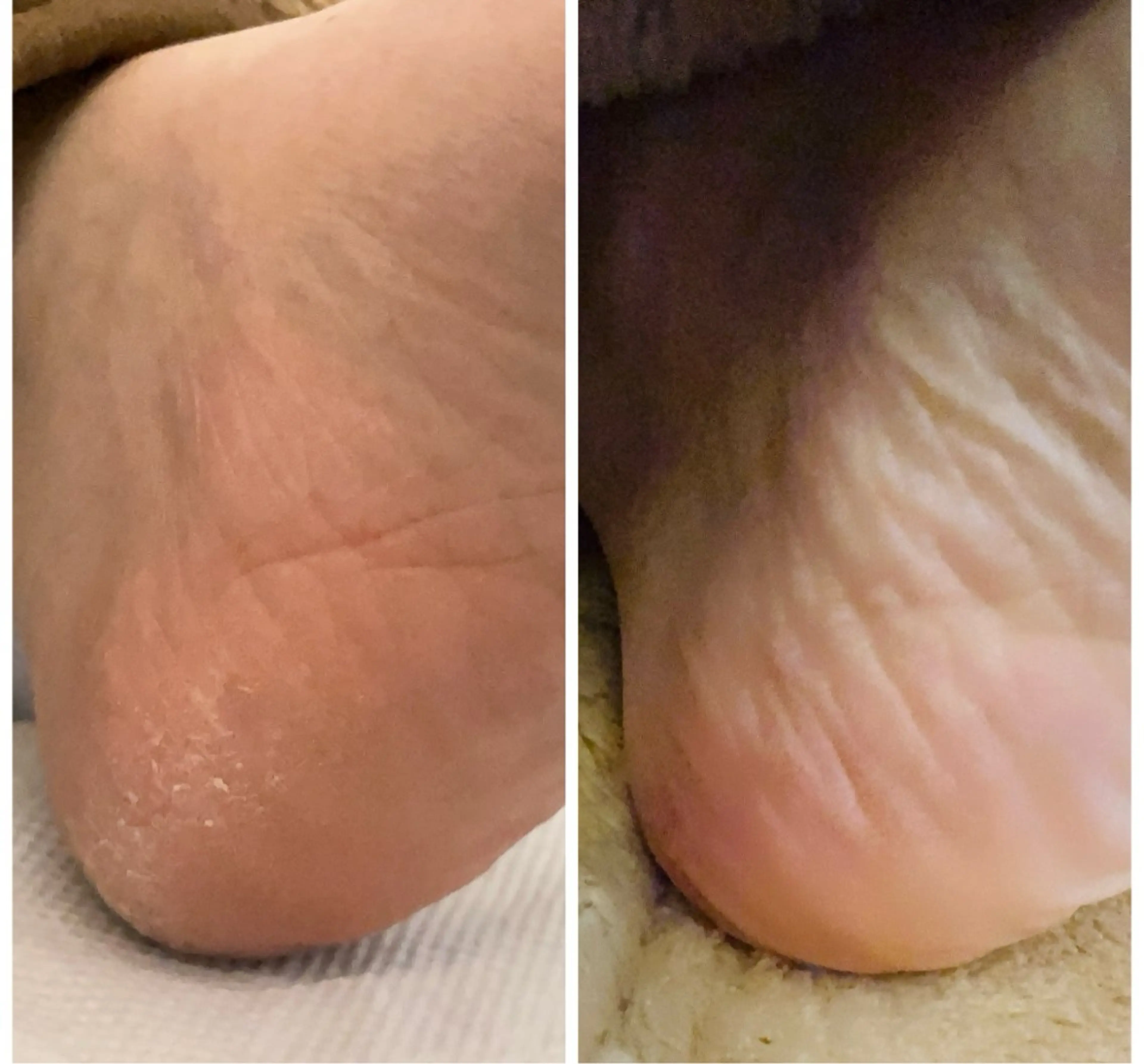 足裏角質＆フットマッサージで冷えむくみ解消の写真