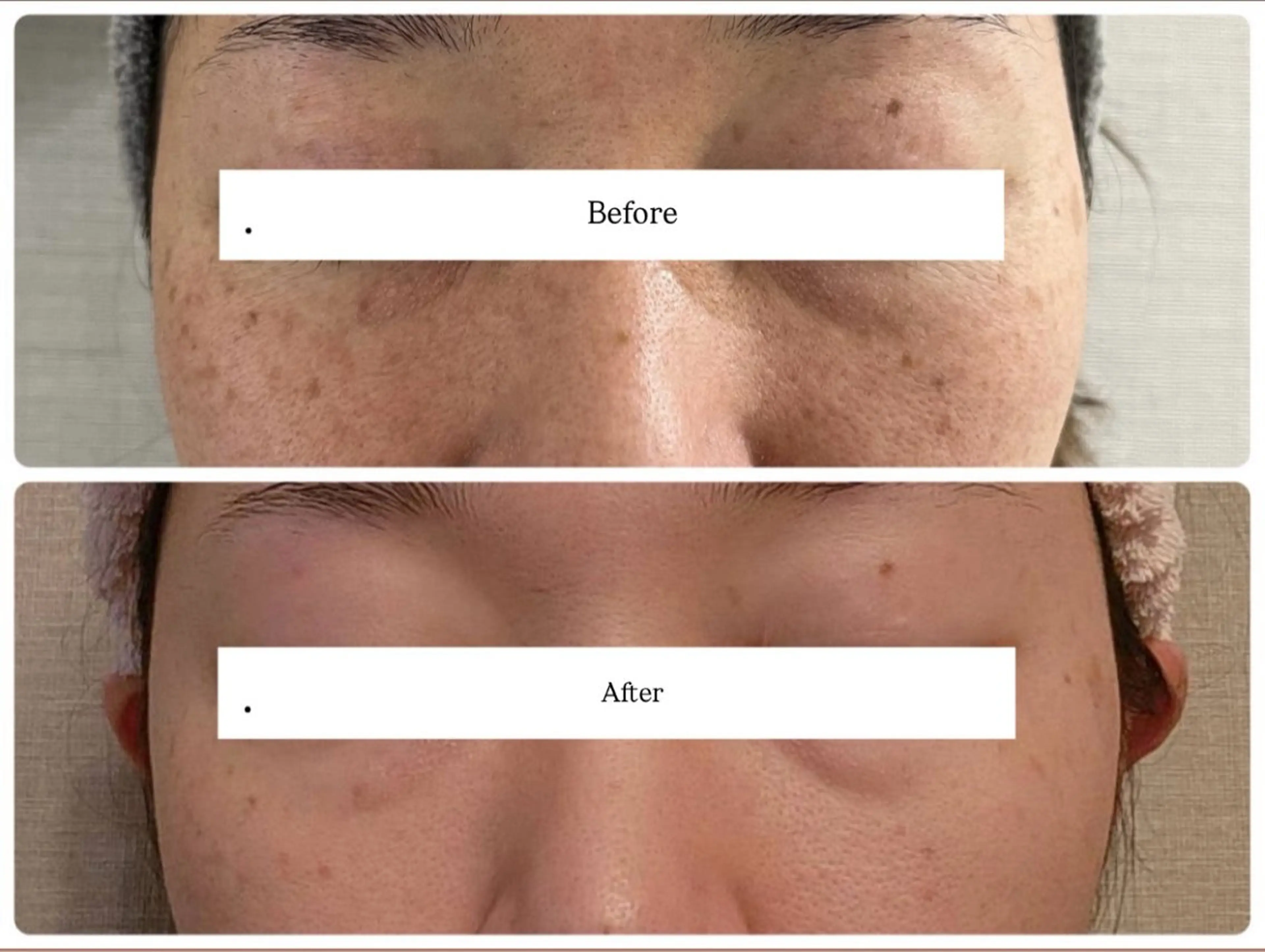 しみシワたるみ撃退コース✨（顔、肩首、デコルテ、ヘッドマッサージ、美白パック、白玉美容液導入）の写真