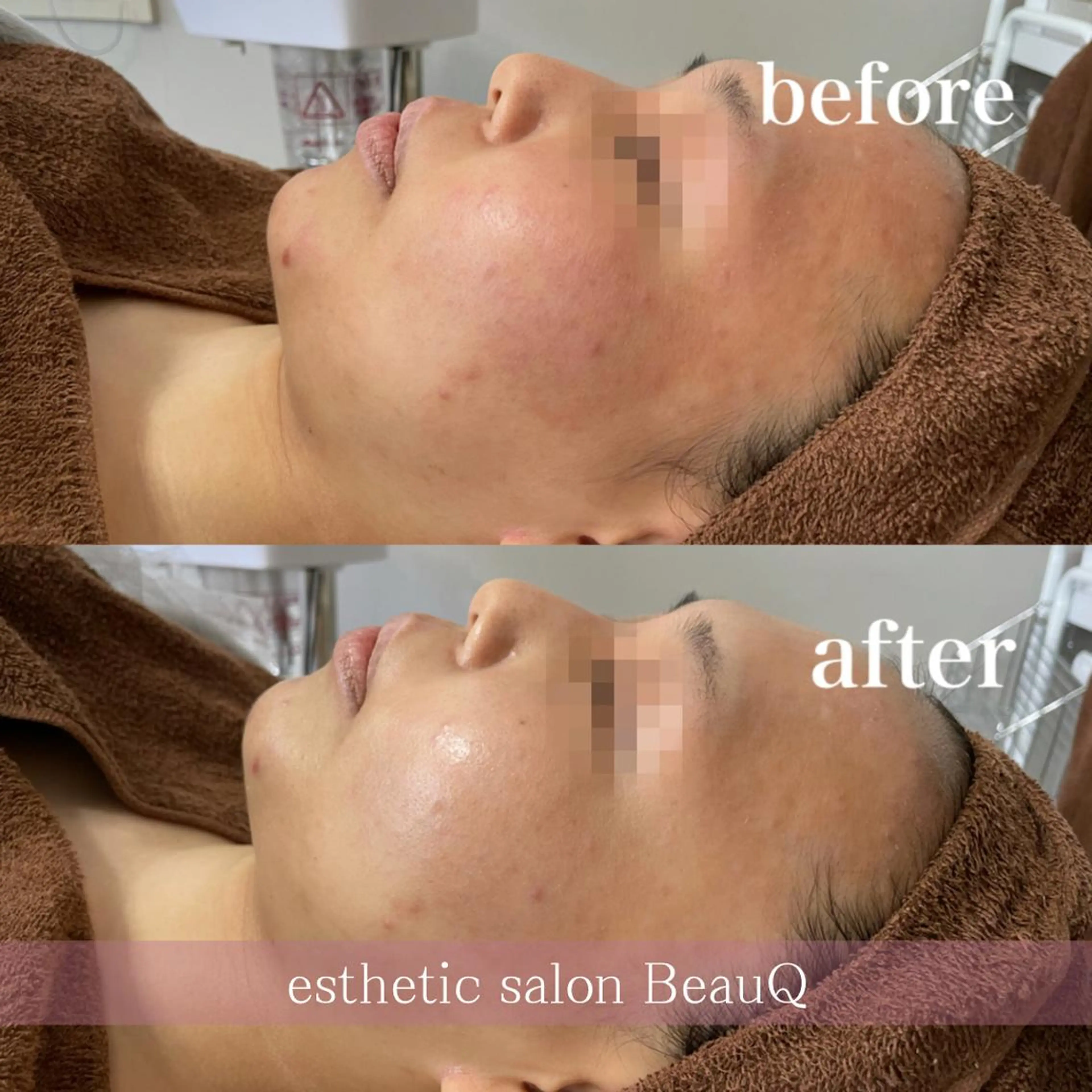 肌質改善/ブライダル 水上百華のエステ・リラクイメージ