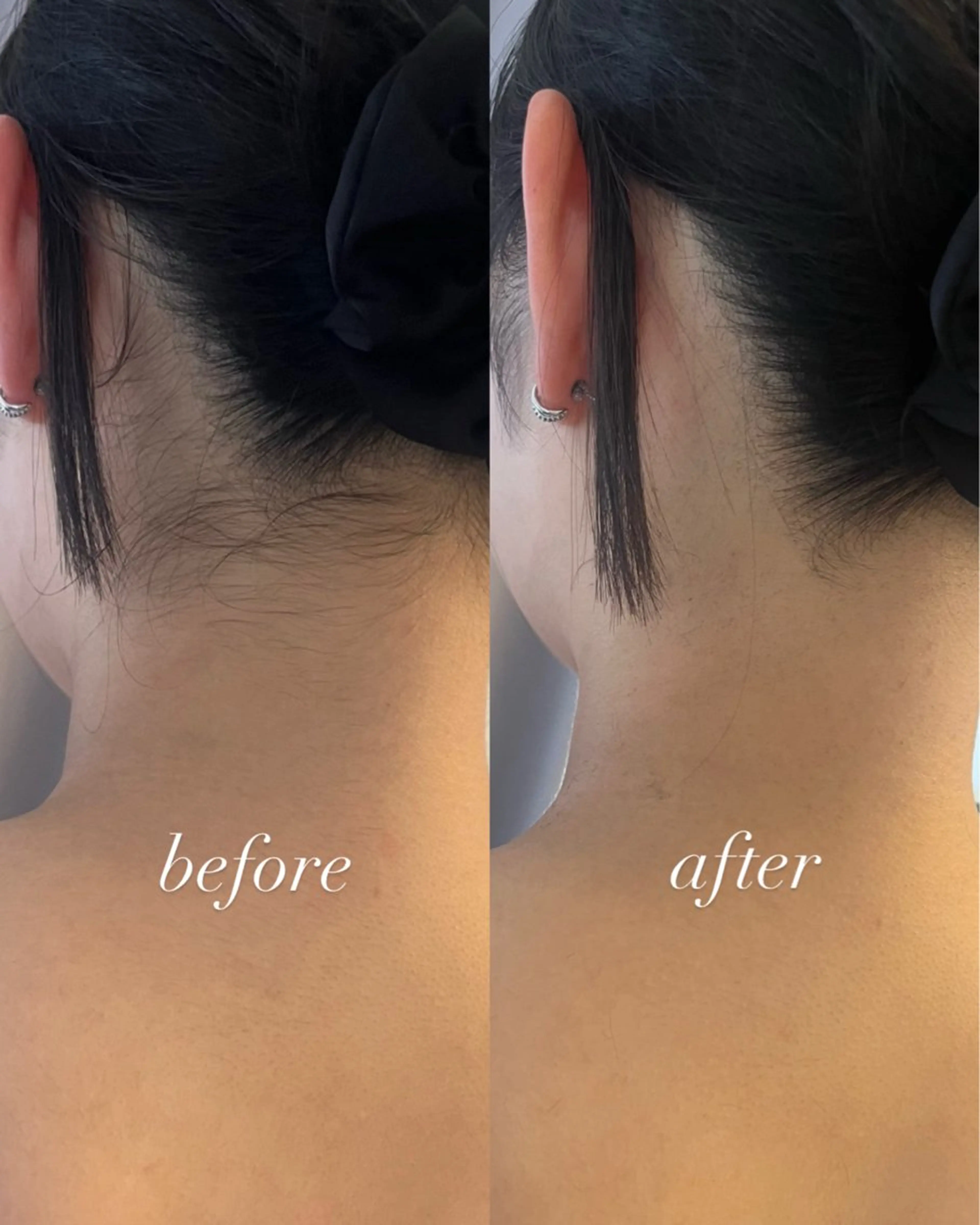 脱毛 うなじ脱毛/美肌脱毛 LABELのエステ・リラクイメージ