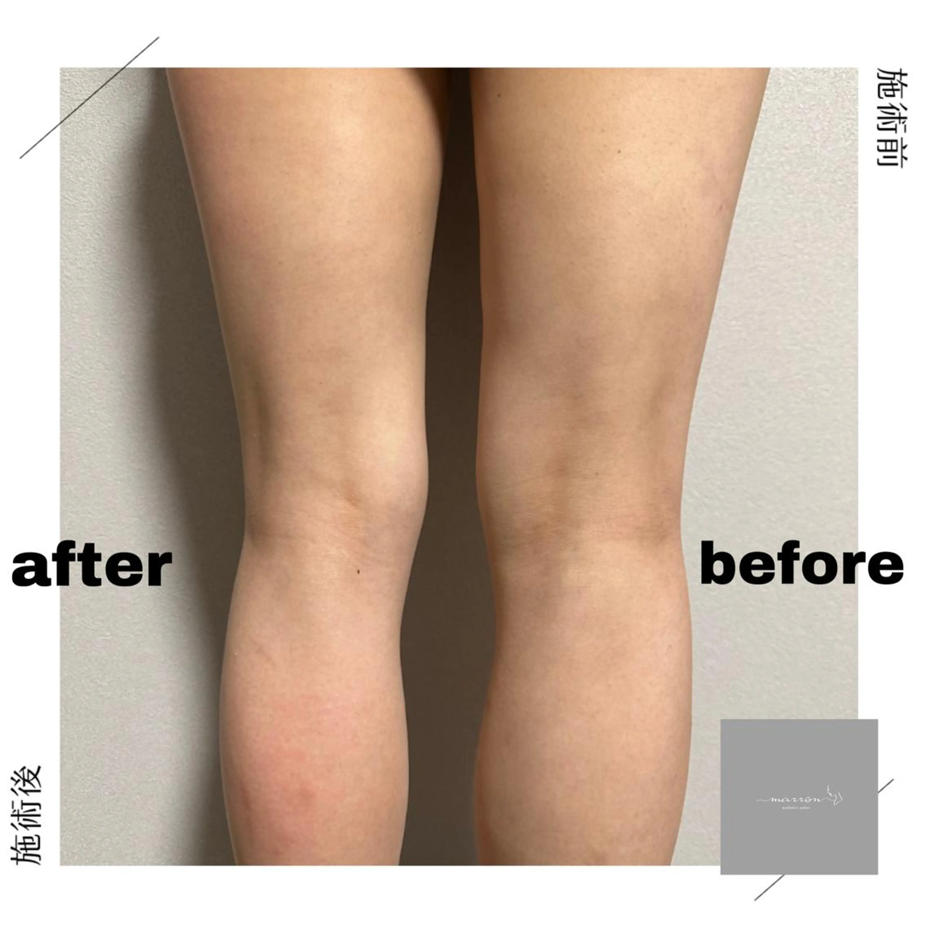 marron所属・痩身ハイパーナイフ ララピールリアボーテのエステ・リラクイメージ