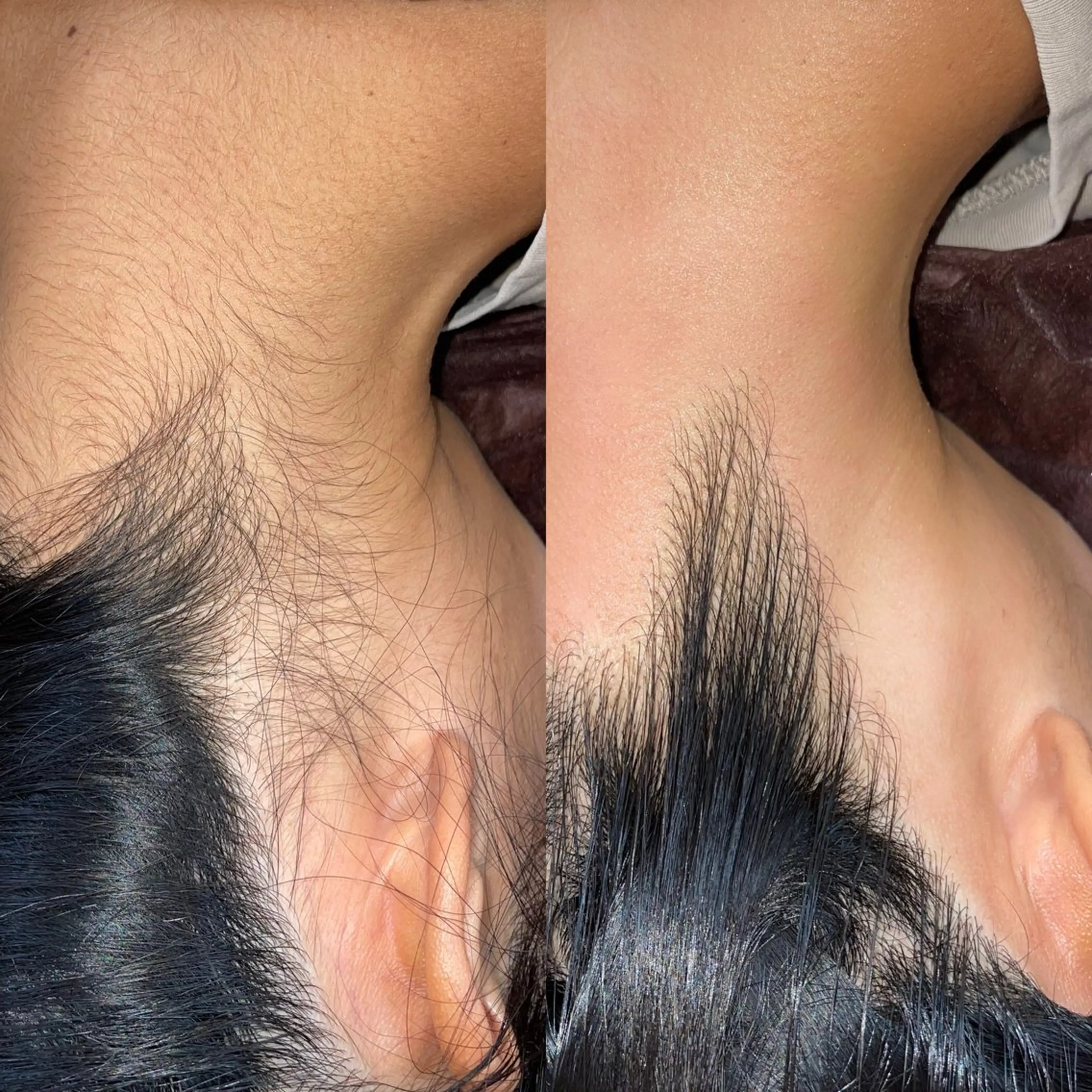 うなじワックス脱毛の写真