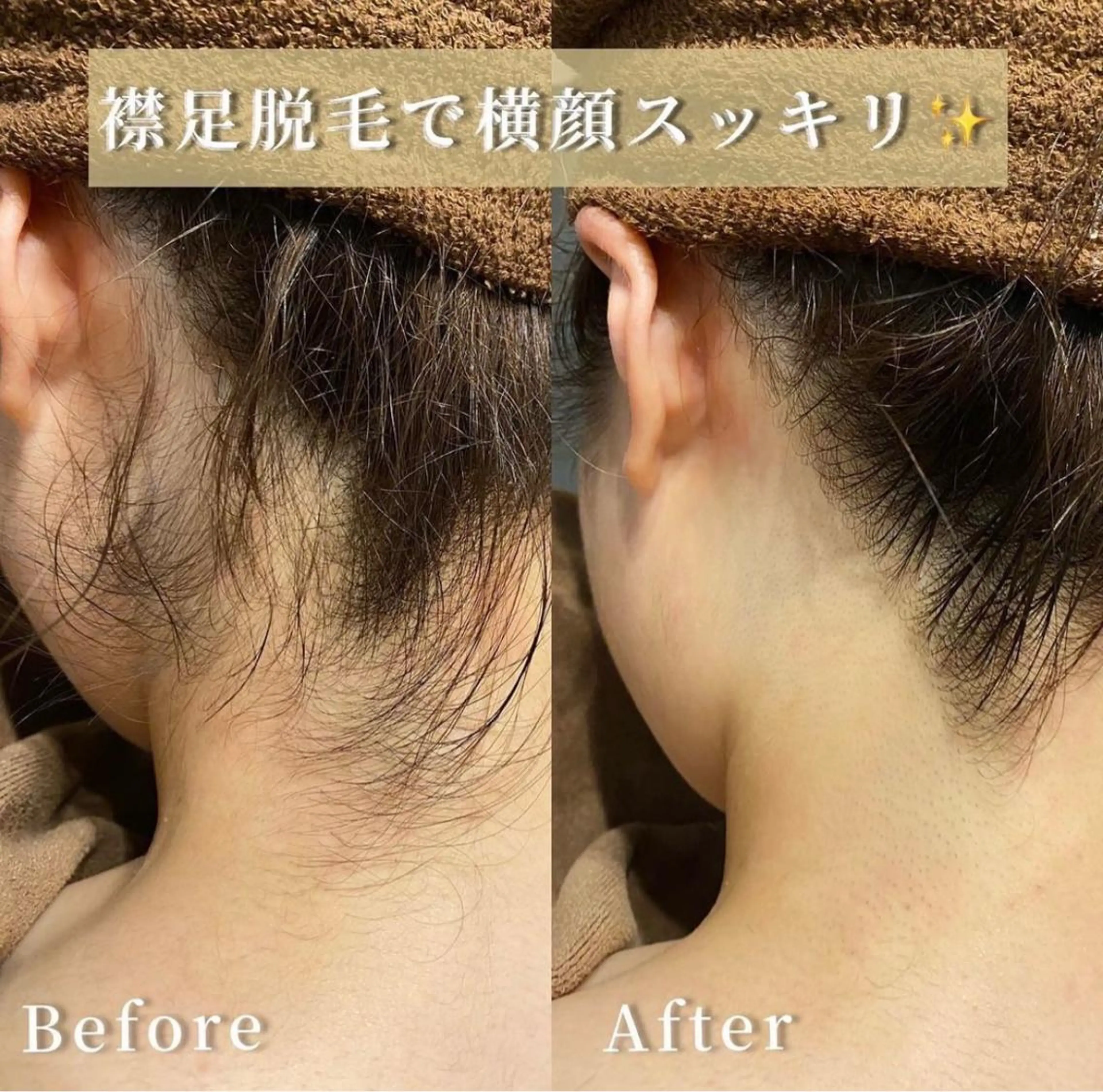 レディースうなじ脱毛✨の写真