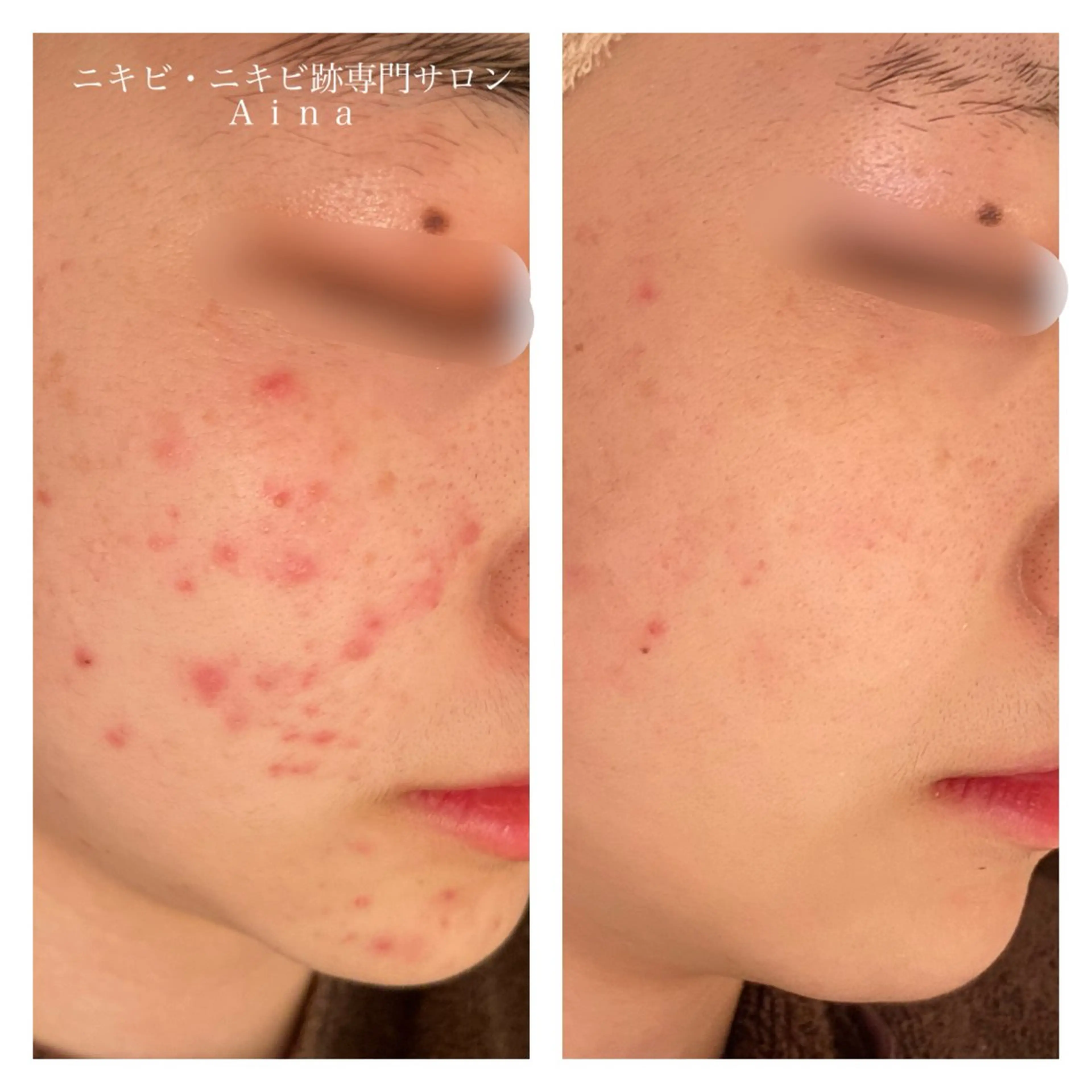 エステ リラク ニキビ跡専門サロン Ainaのエステ・リラクイメージ