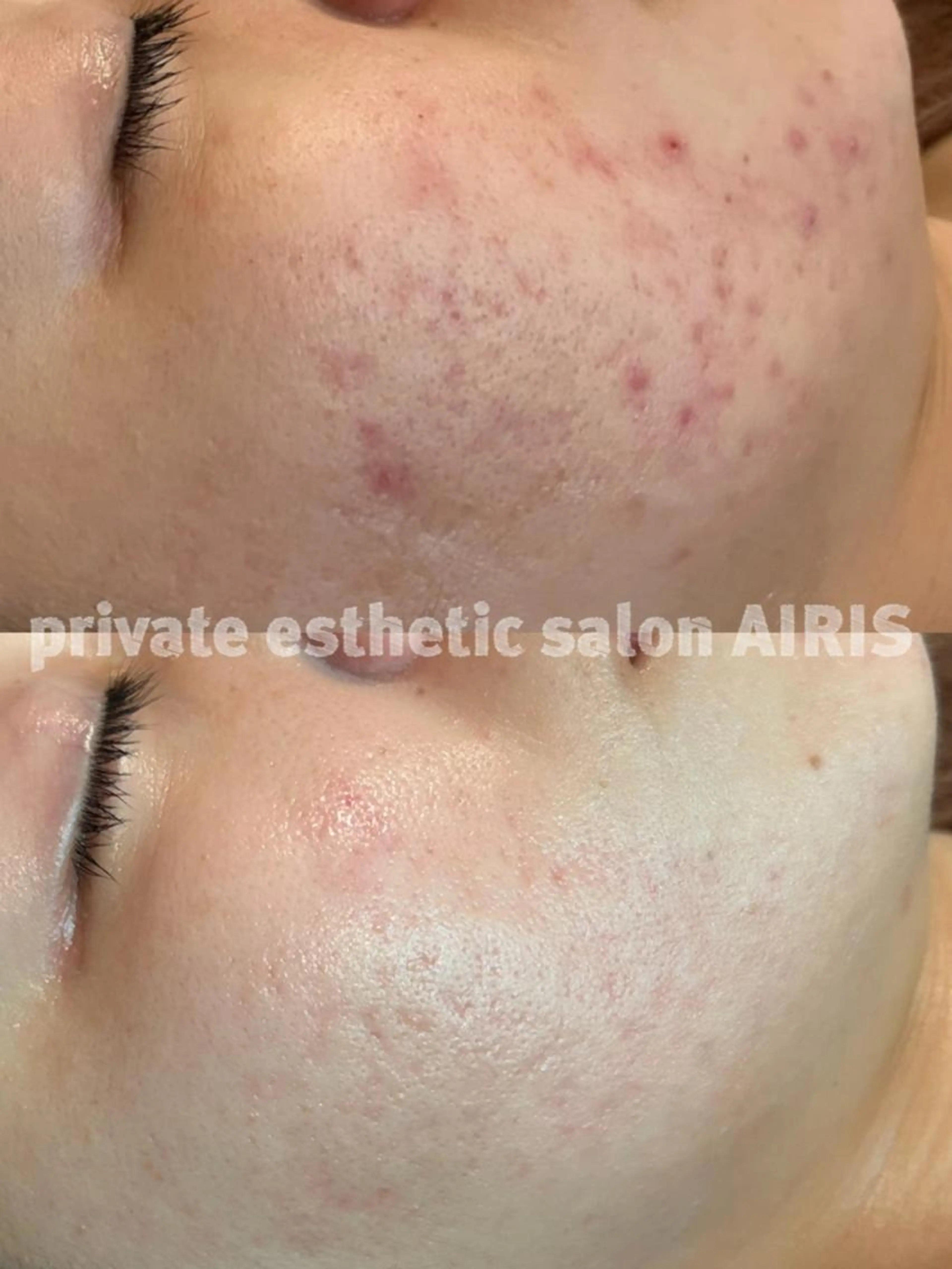 【12月末迄の限定☆】クリスティーナハーブピーリング＋頭皮カッサ＋顔マッサージ16,500円→7,900円の写真