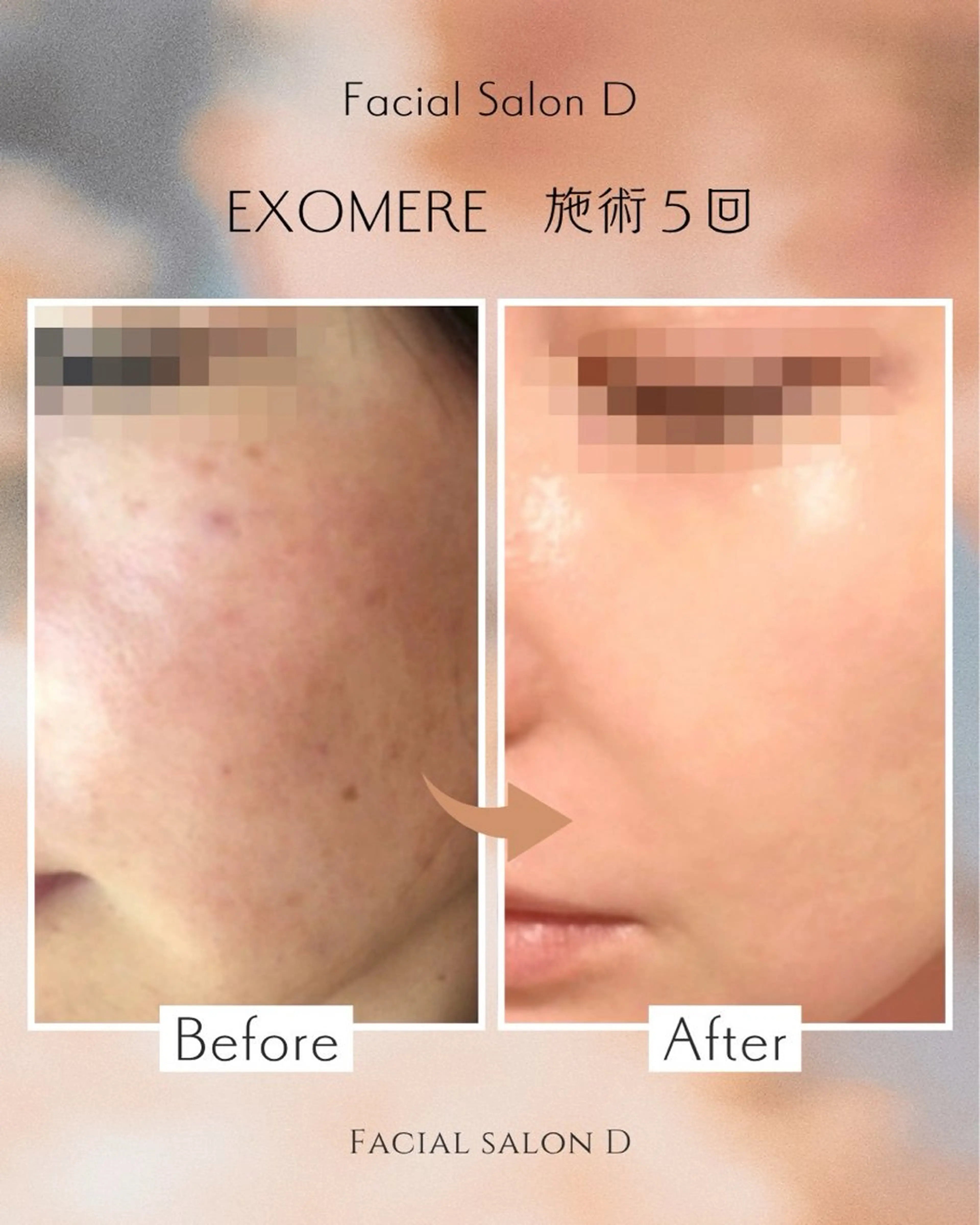 【プレミアム】次世代フェイシャル⭐︎特許技術で肌再生シミ/シワ/毛穴（ソフトシェービング付）￥14000→￥6720の写真