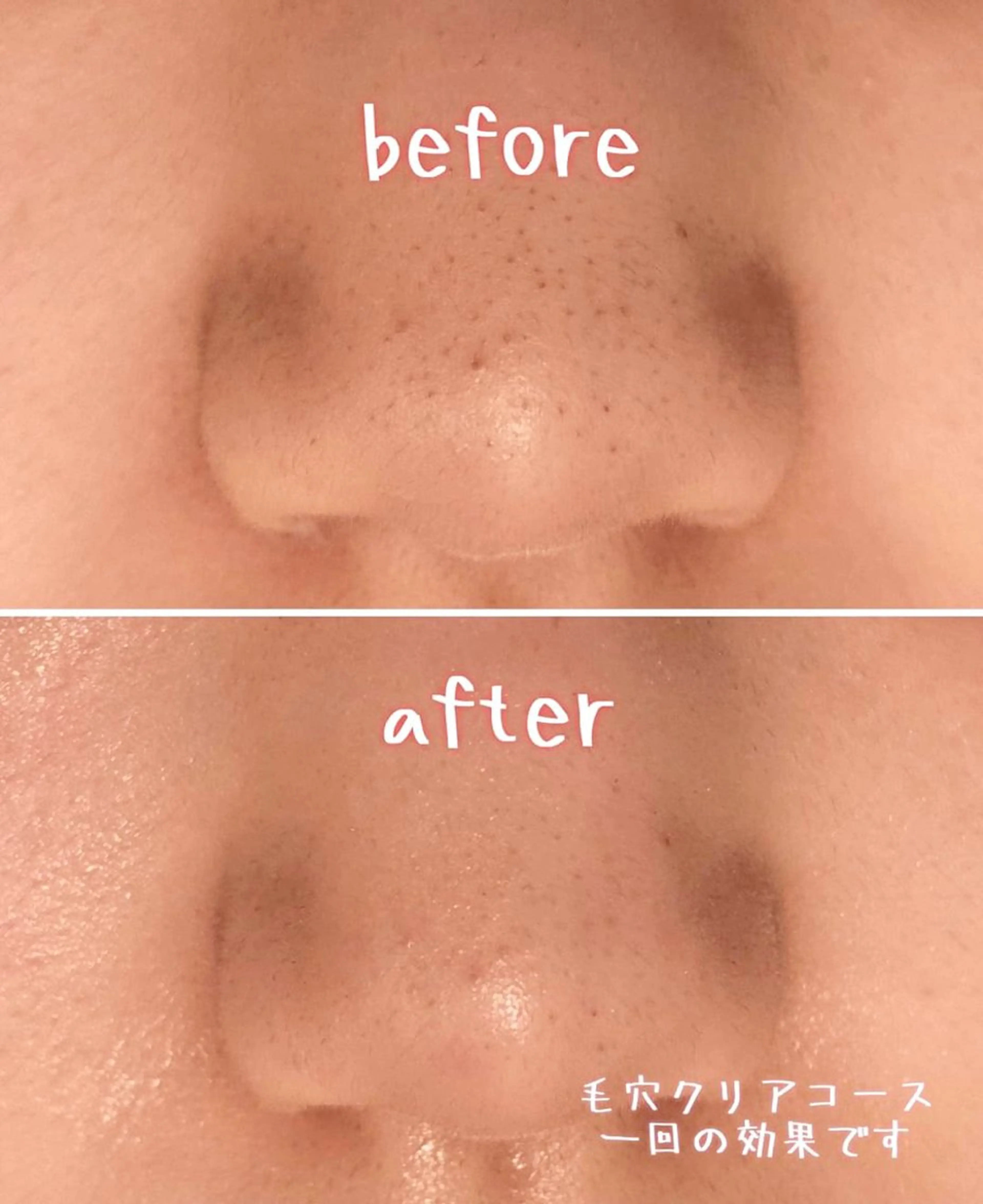 毛穴クリアコースの写真