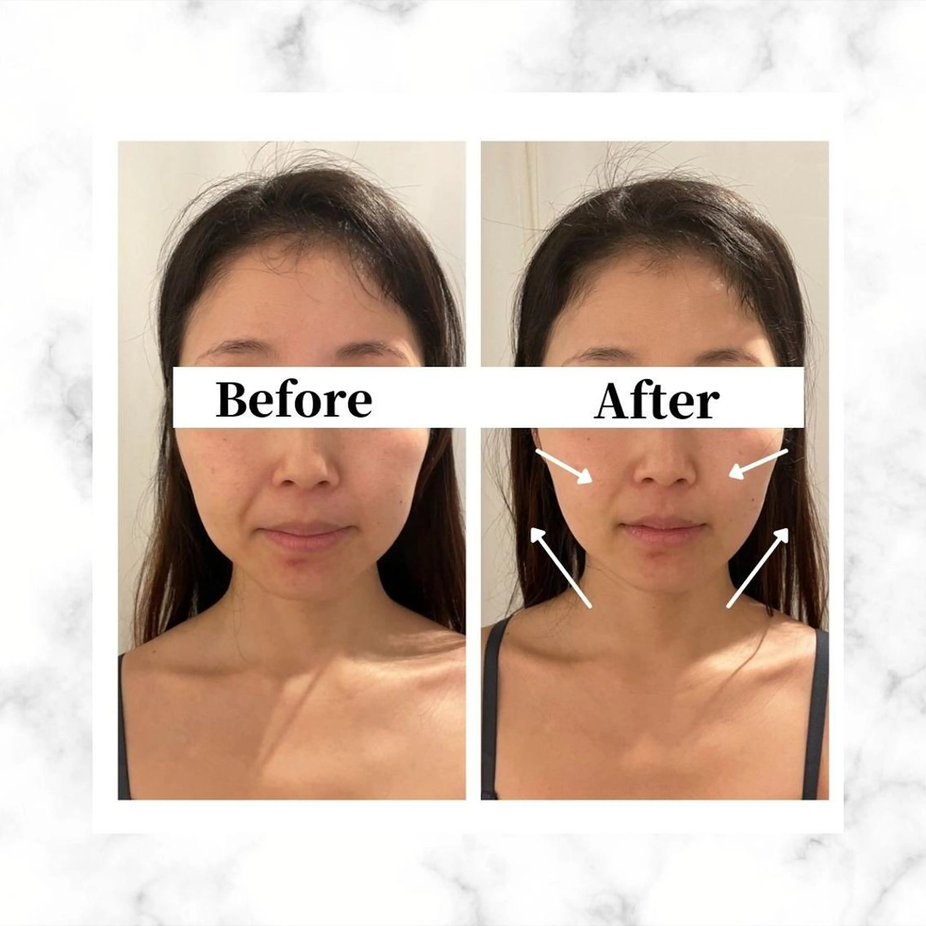 エステ リラク 12Dハイフ💗 最強小顔のエステ・リラクイメージ