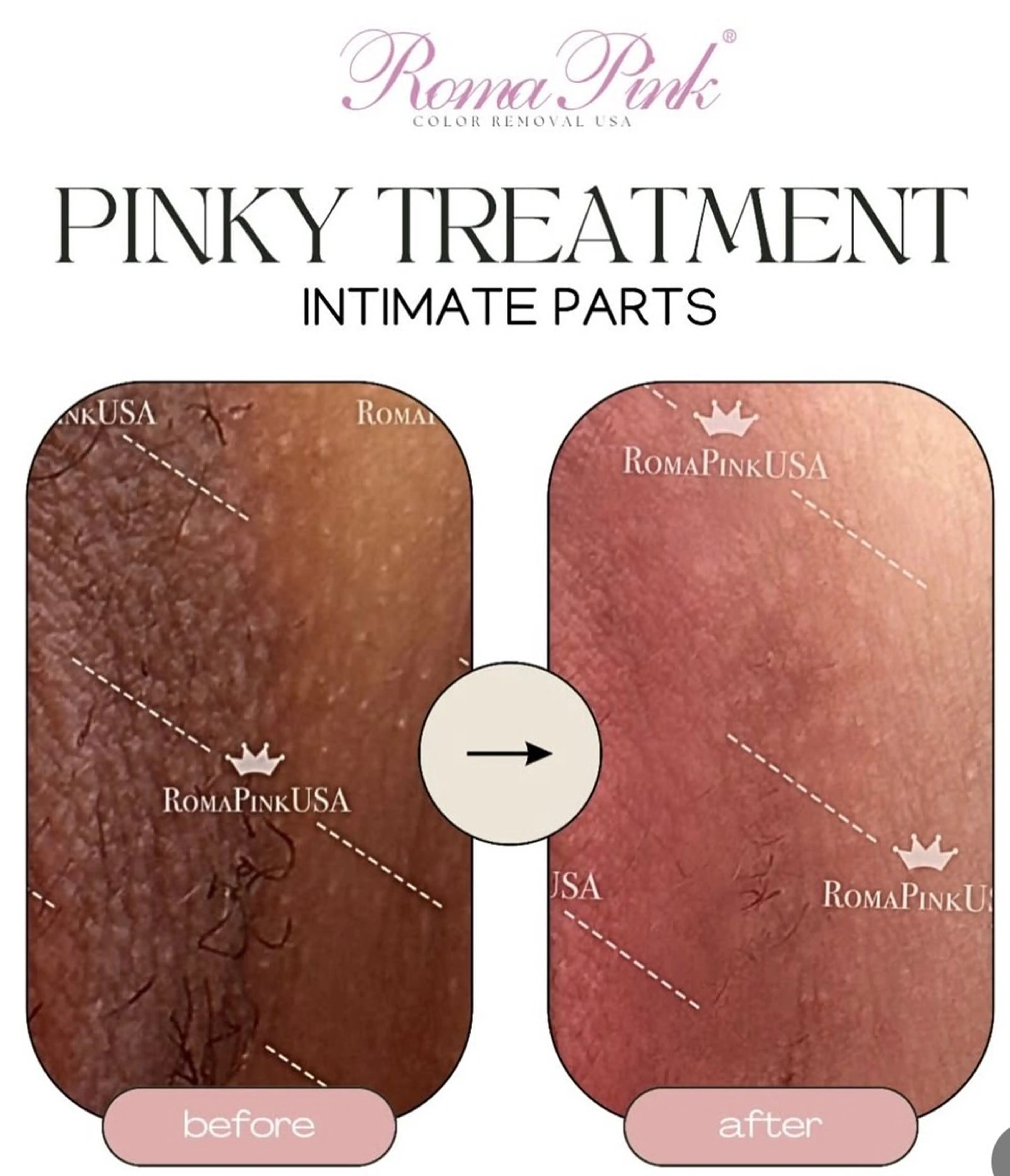 業界で話題！山梨初上陸✨【ローマピンク💋】陰部（VI）¥250,000→¥150,000🎀※アフタークリーム1本付の写真
