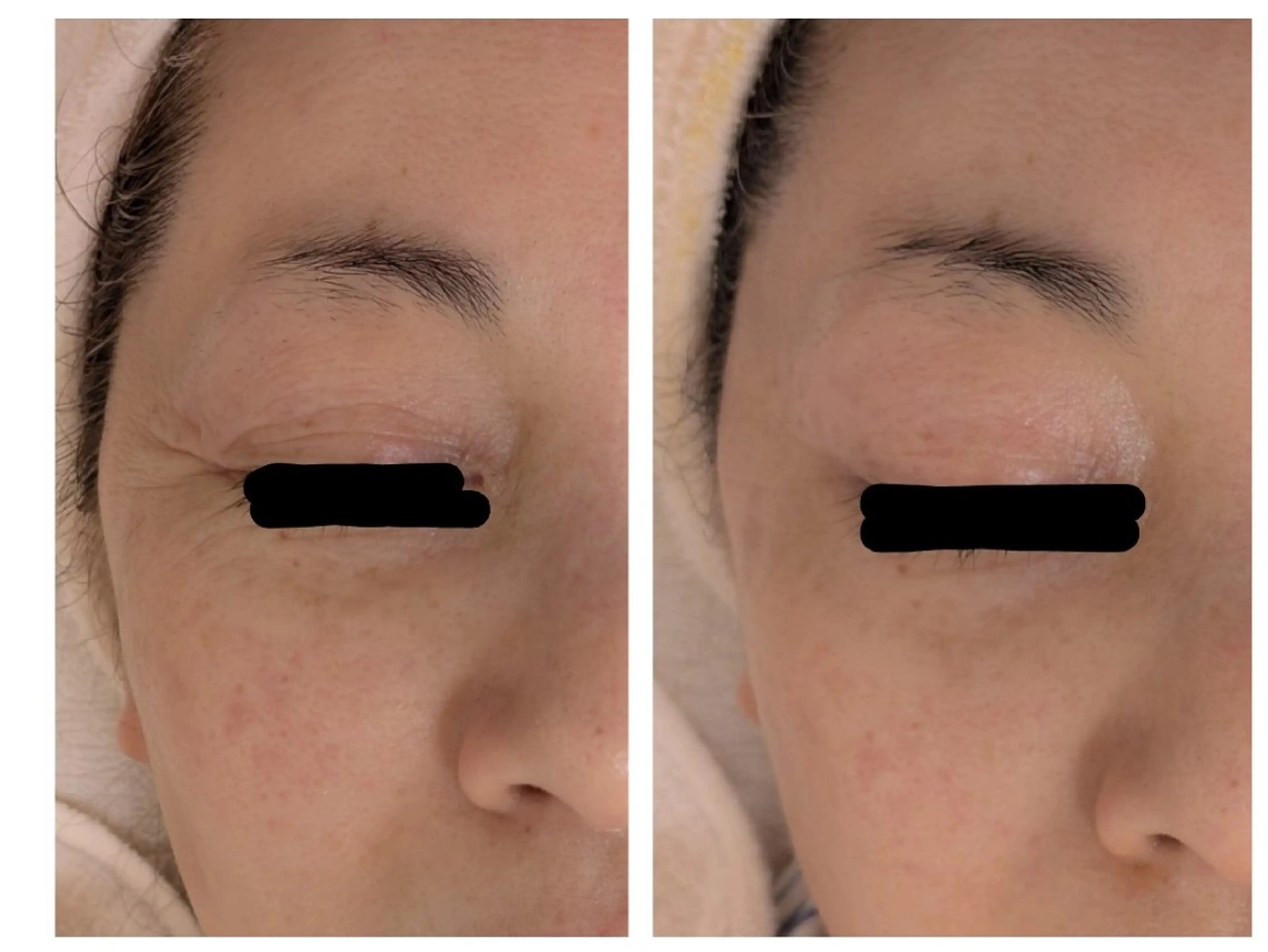 レチノール/ニキビ/ 毛穴ケア　浅川のエステ・リラクイメージ