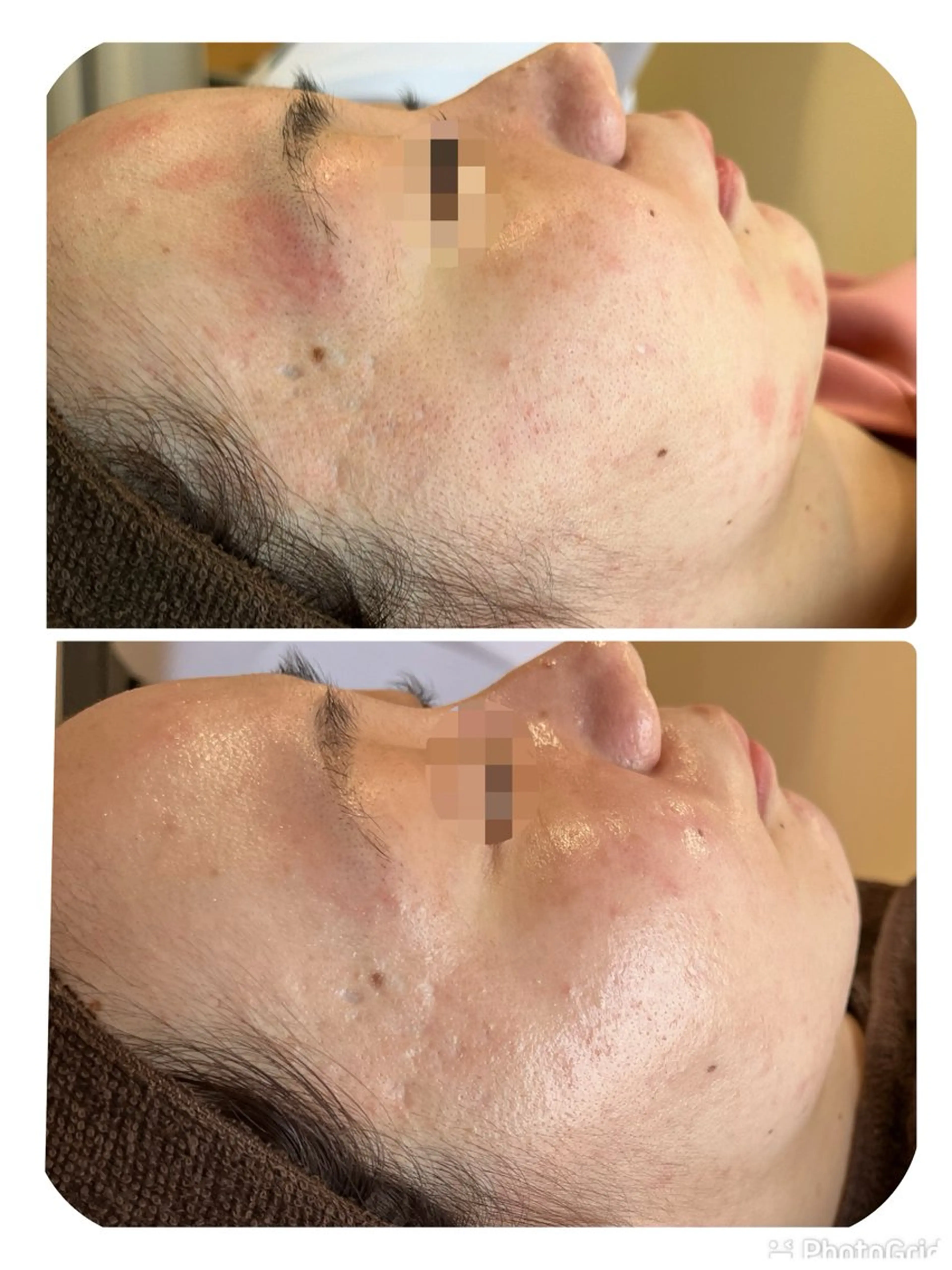 エステ 【リベルハーブピーリング認定店】敏感肌・美白脱毛専門店Dione立川店所属・Dione 立川店のエステ・リラクイメージ