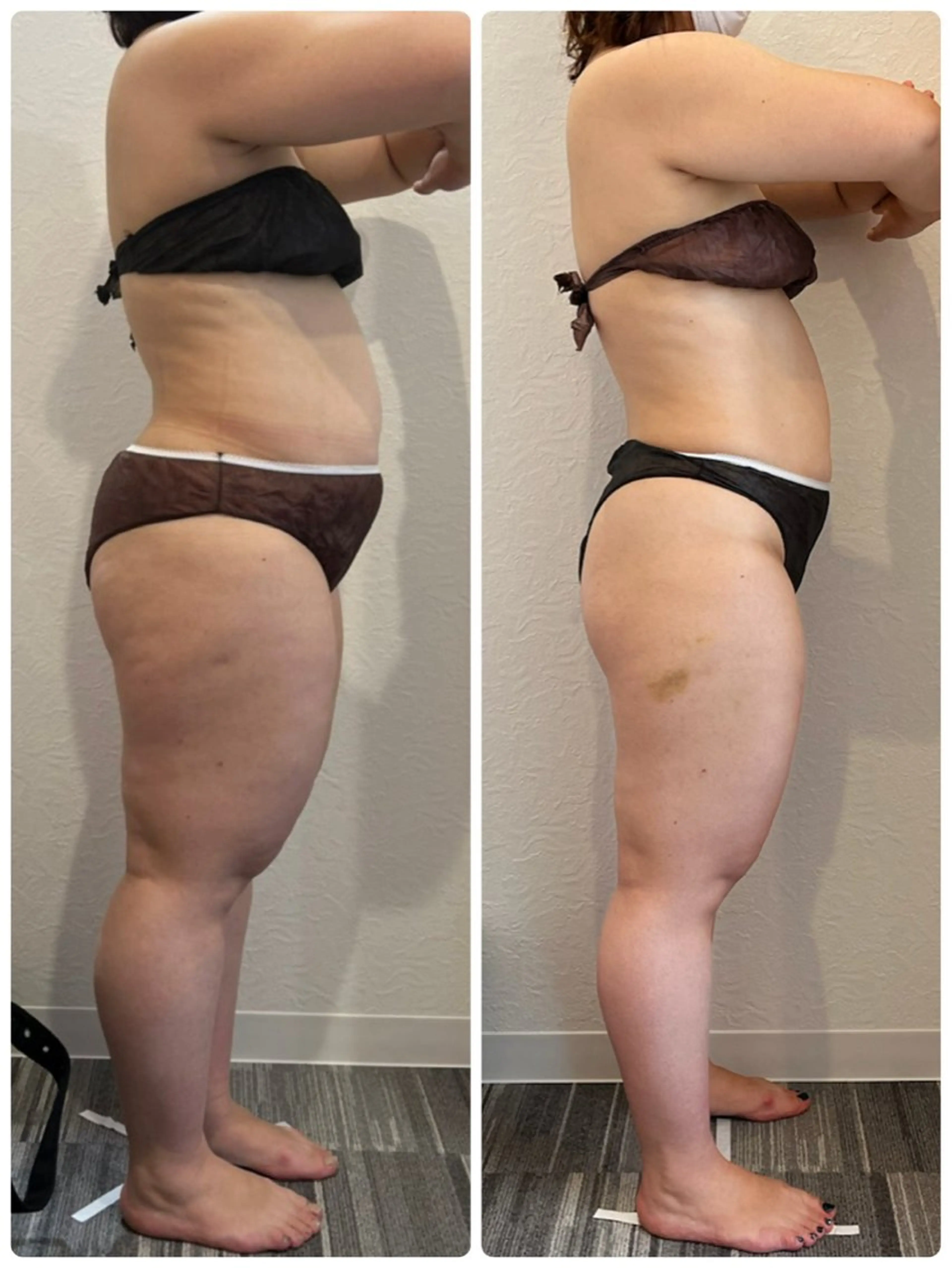 【痩身】30分で5万回分の腹筋運動実現!!最先端技術電磁パルス痩身30分¥3980の写真